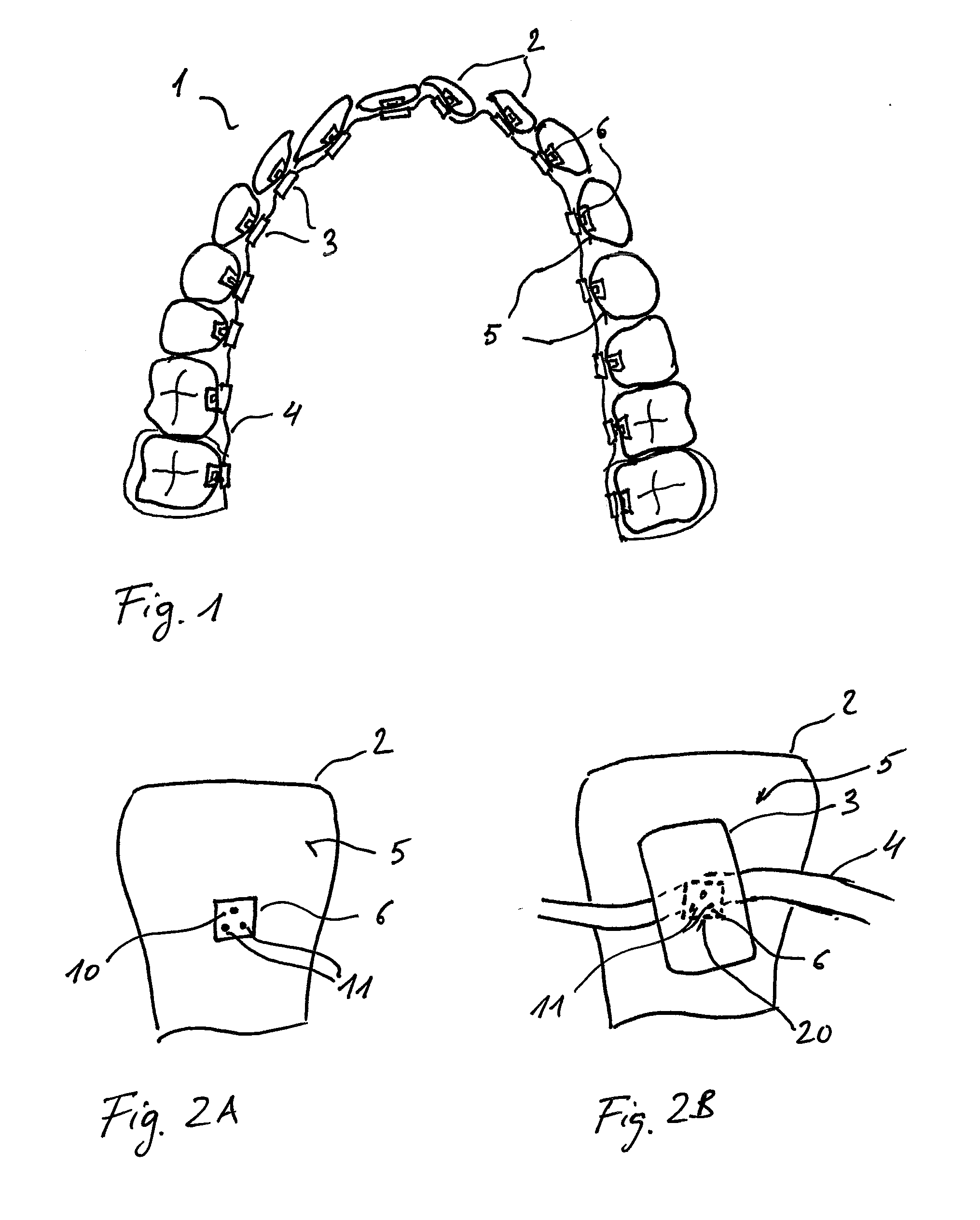 Bracket system and method for planning and producing a bracket system for the correction of tooth malpositions