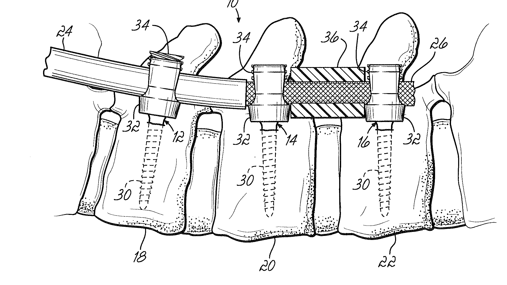 Spinal stabilization system with rigid and flexible elements