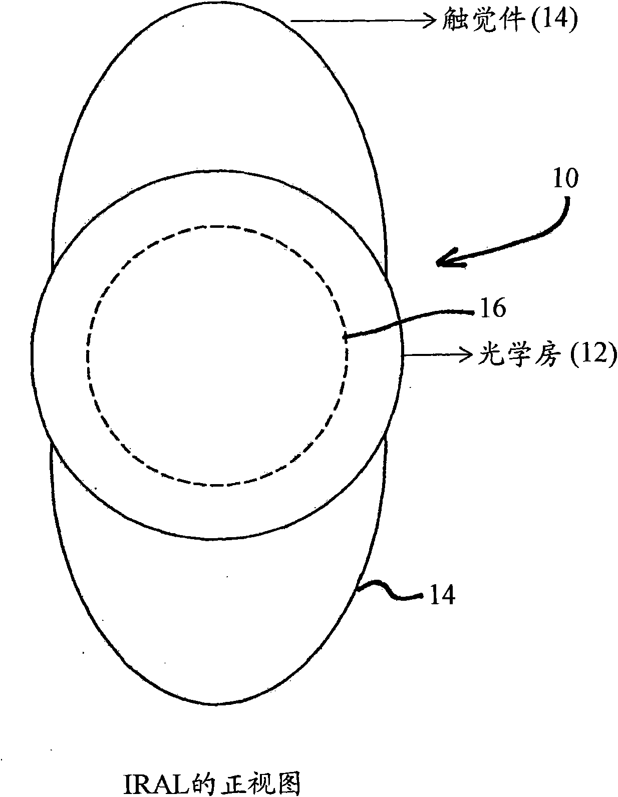 Interfacial refraction accommodating lens (iral)