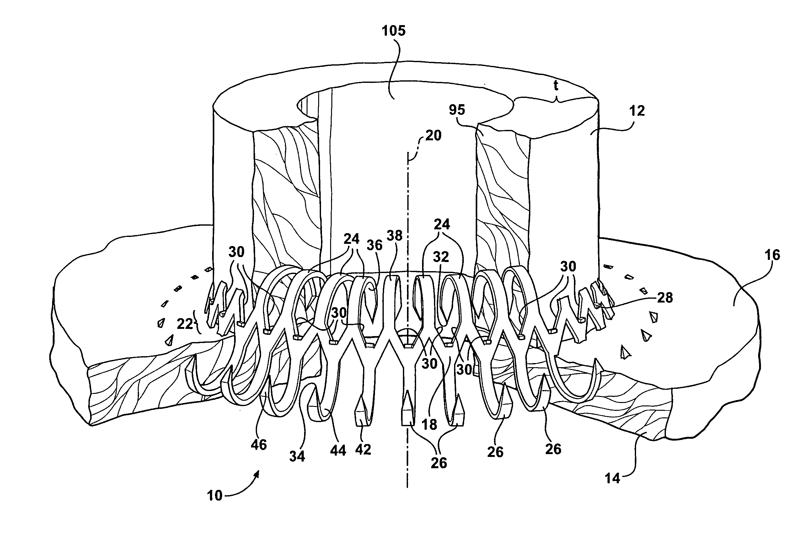 Anastomosis apparatus and methods of deployment and manufacture