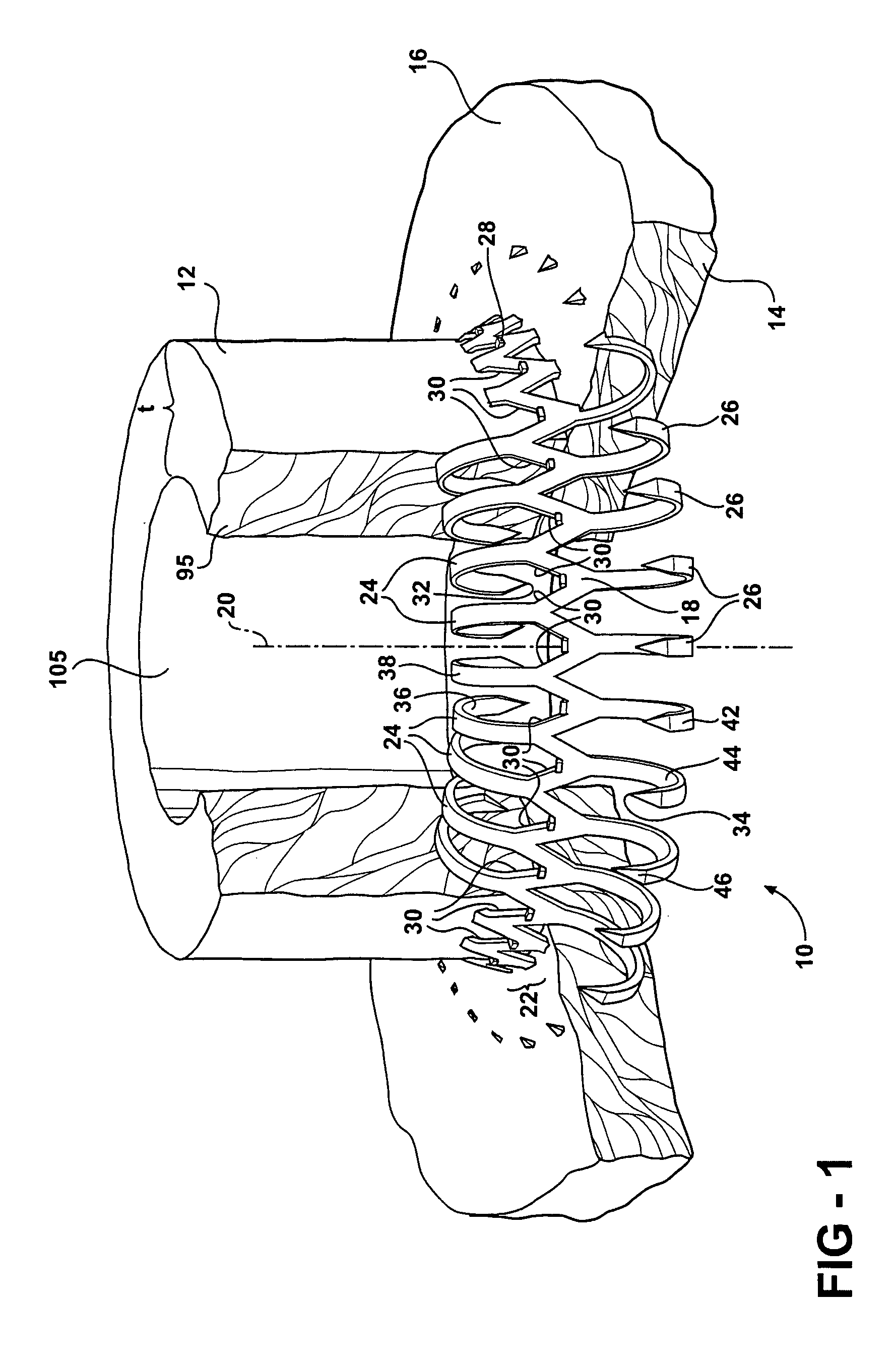 Anastomosis apparatus and methods of deployment and manufacture