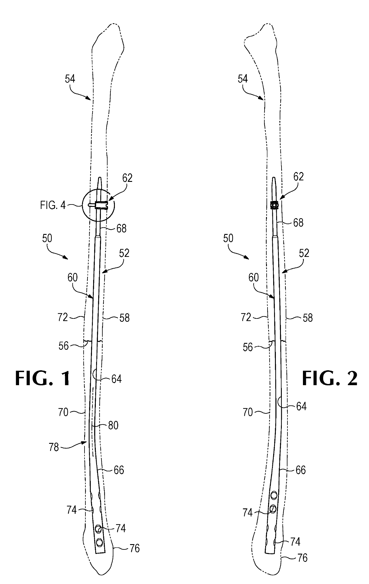 System and method for bone fixation using a nail locked to an encircling anchor