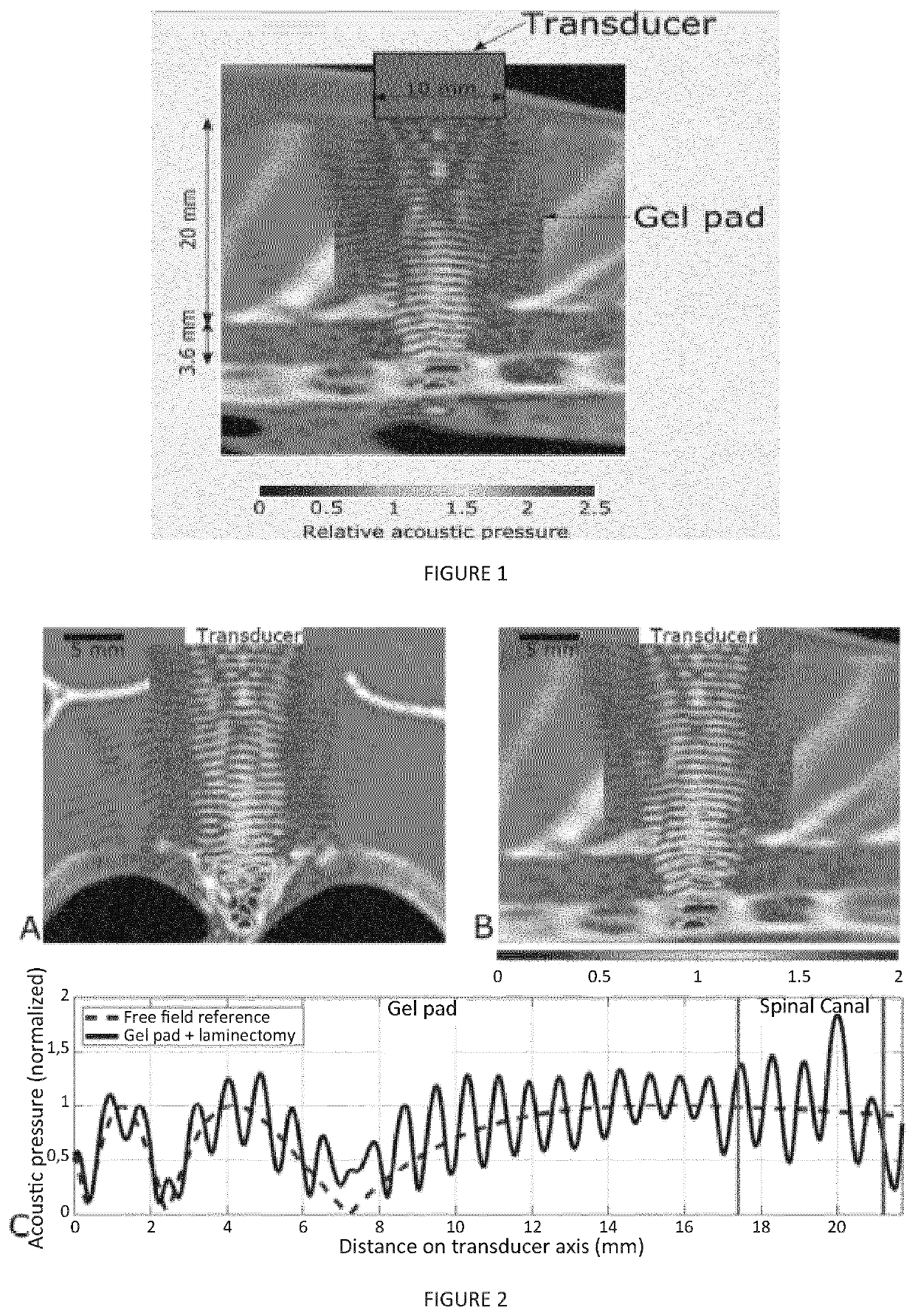 Implantable ultrasound generating device for implantation within a vertebral column