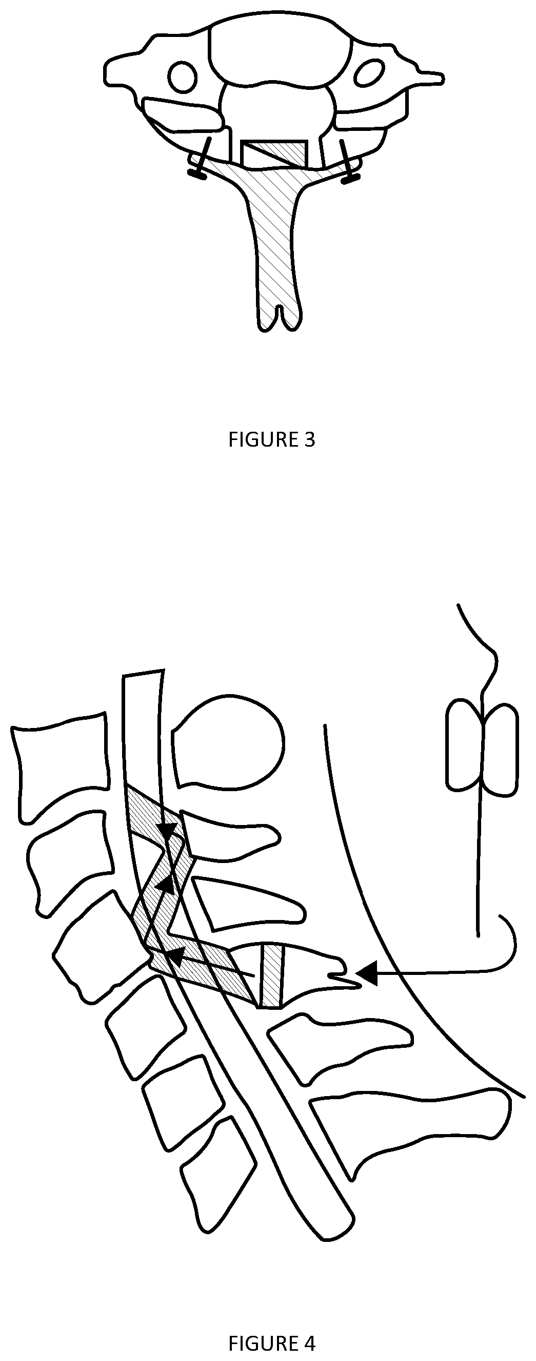 Implantable ultrasound generating device for implantation within a vertebral column