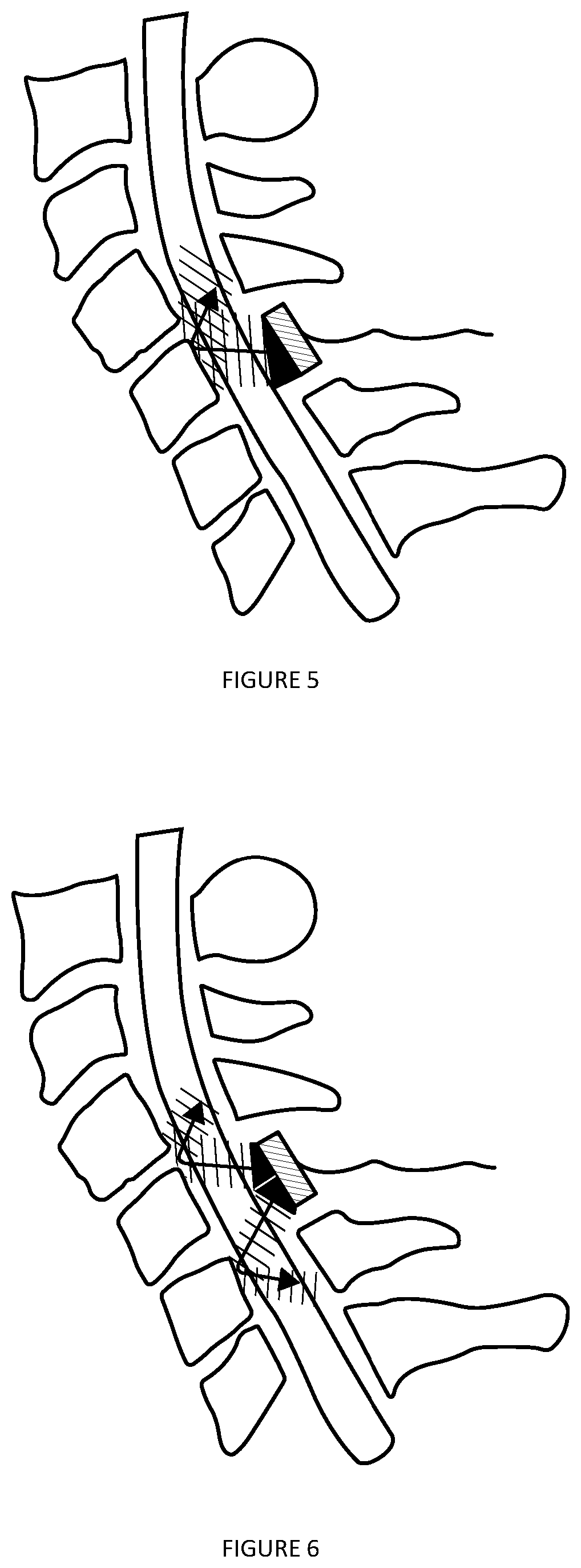 Implantable ultrasound generating device for implantation within a vertebral column