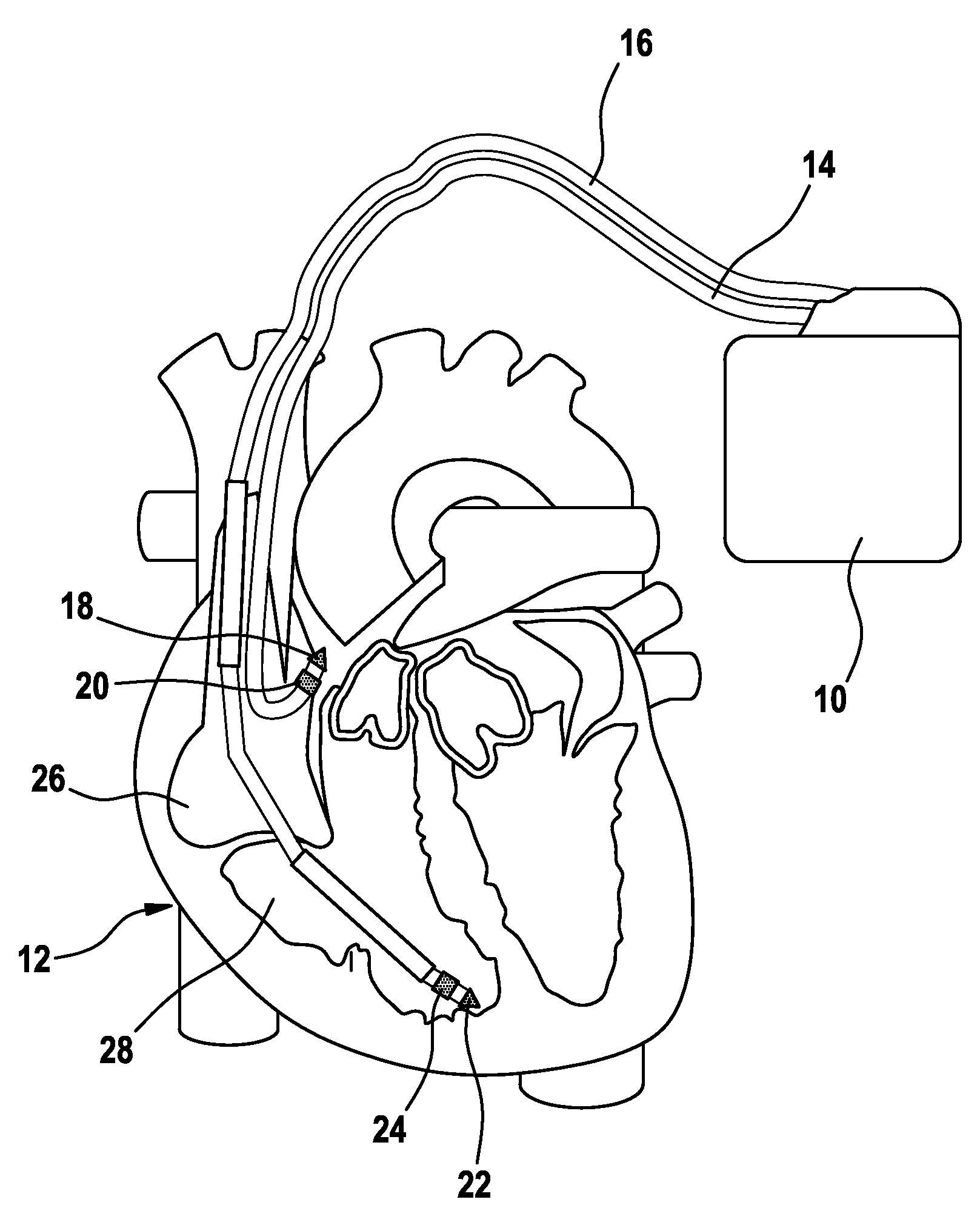 System and method of using regression models to estimate vulnerable periods for heart stimulation parameters