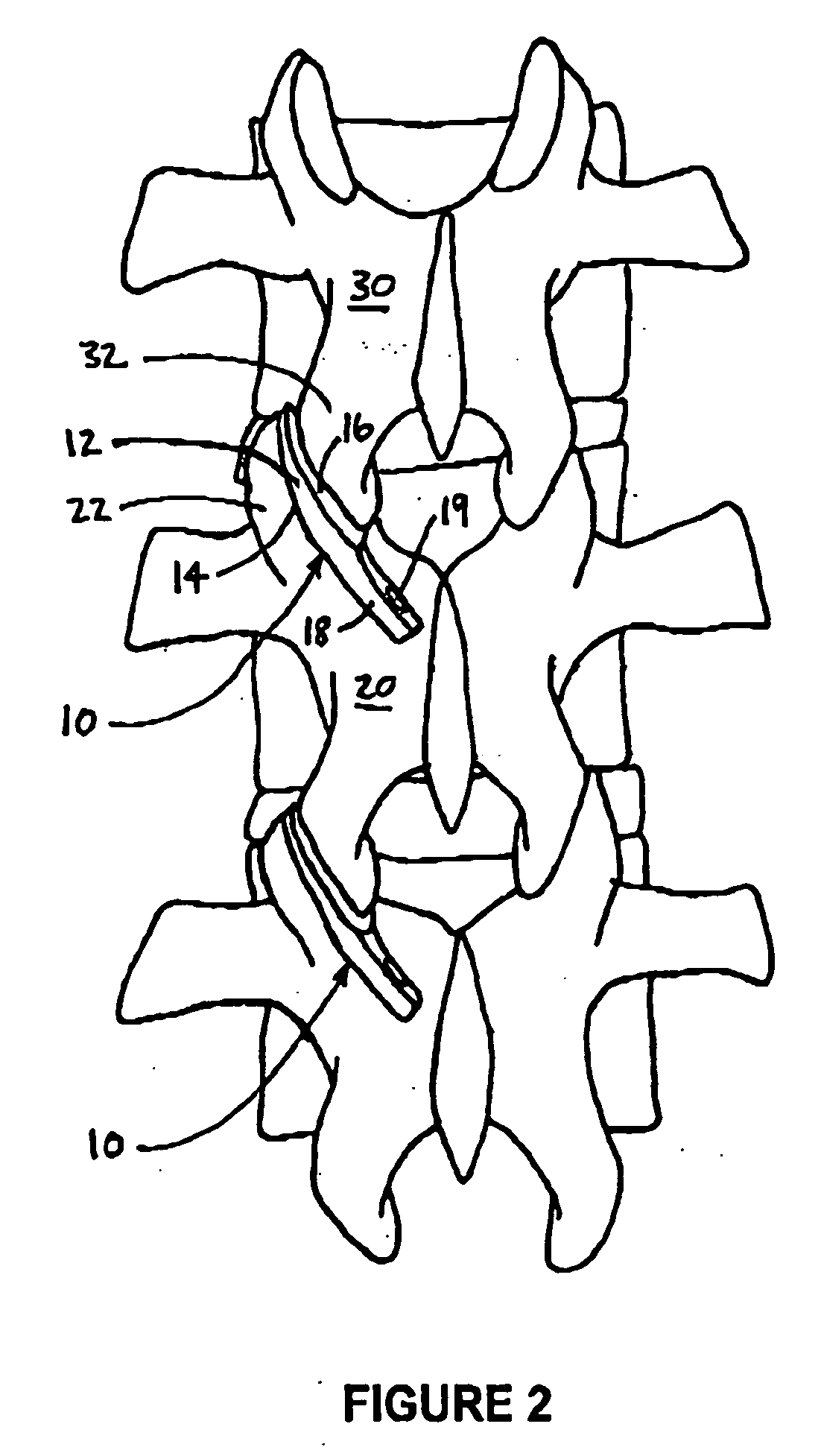 Method and device for treating ailments of the spine