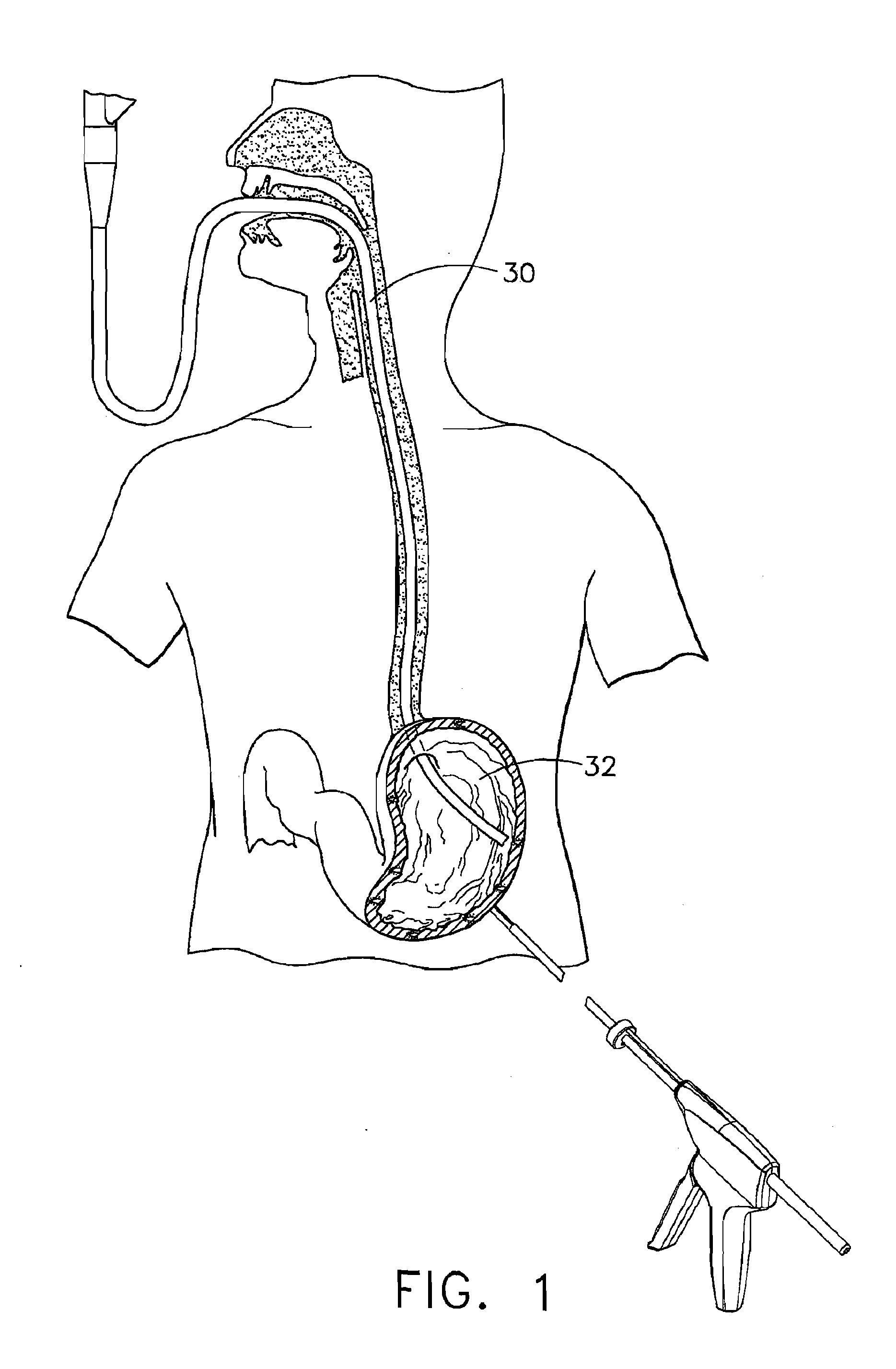 Method of insufflating the interior of a gastric cavity of a patient.