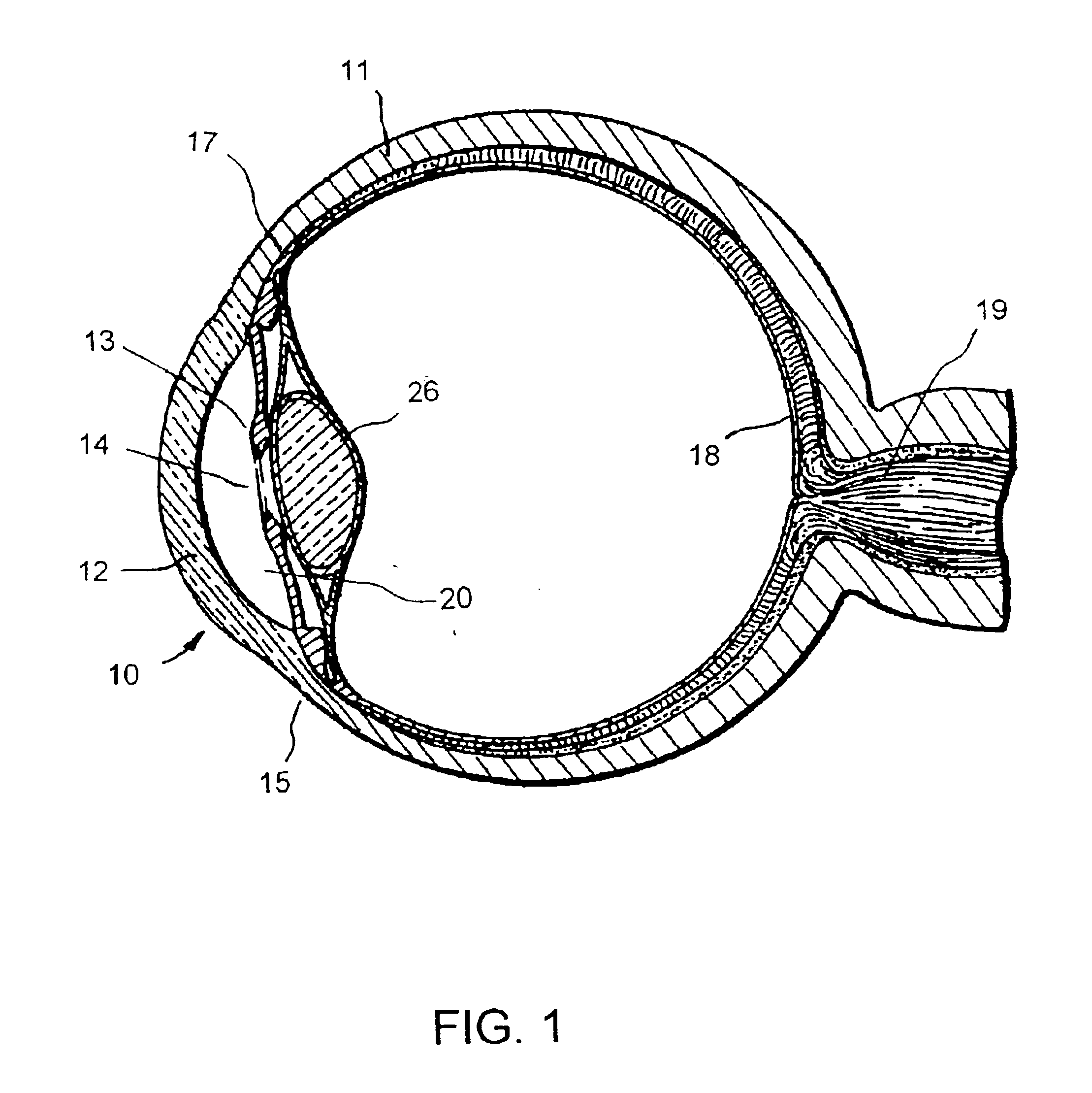 Apparatus and method for treating glaucoma