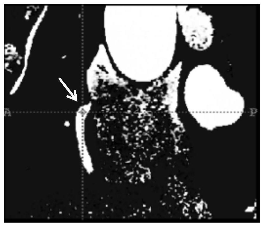 Left ventricle auxiliary device implantation method based on blood flow distribution optimization