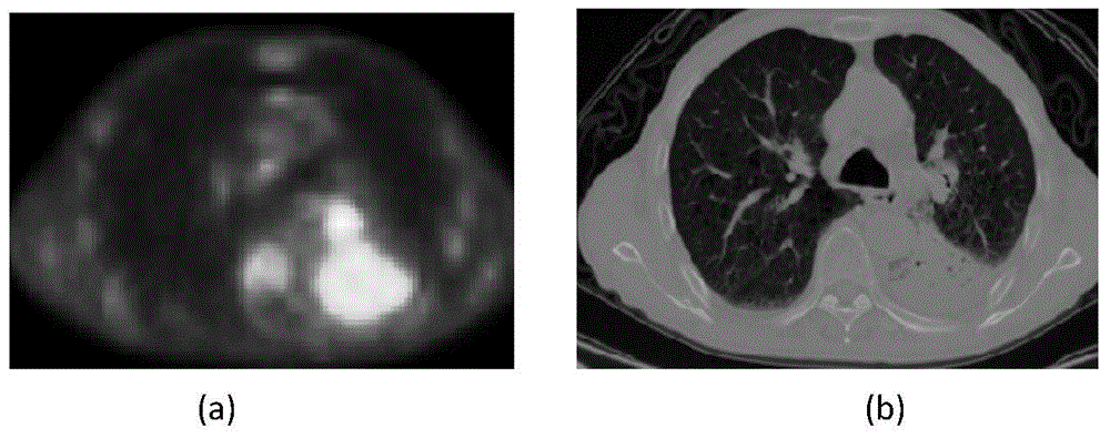 PET-CT lung tumor segmentation method combining three dimensional graph cut algorithm with random walk algorithm