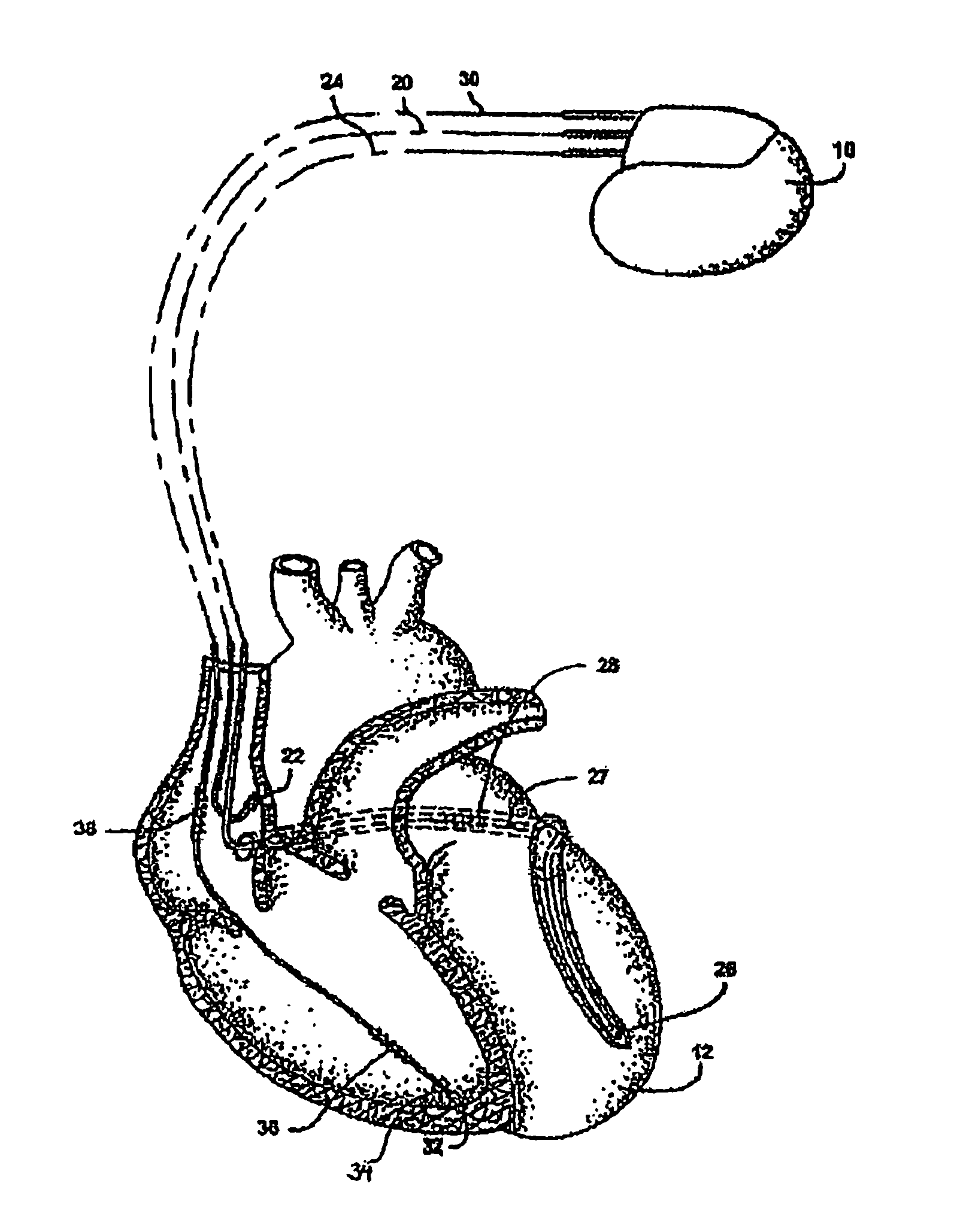 Method and device for switching between arrhythmia prevention modes