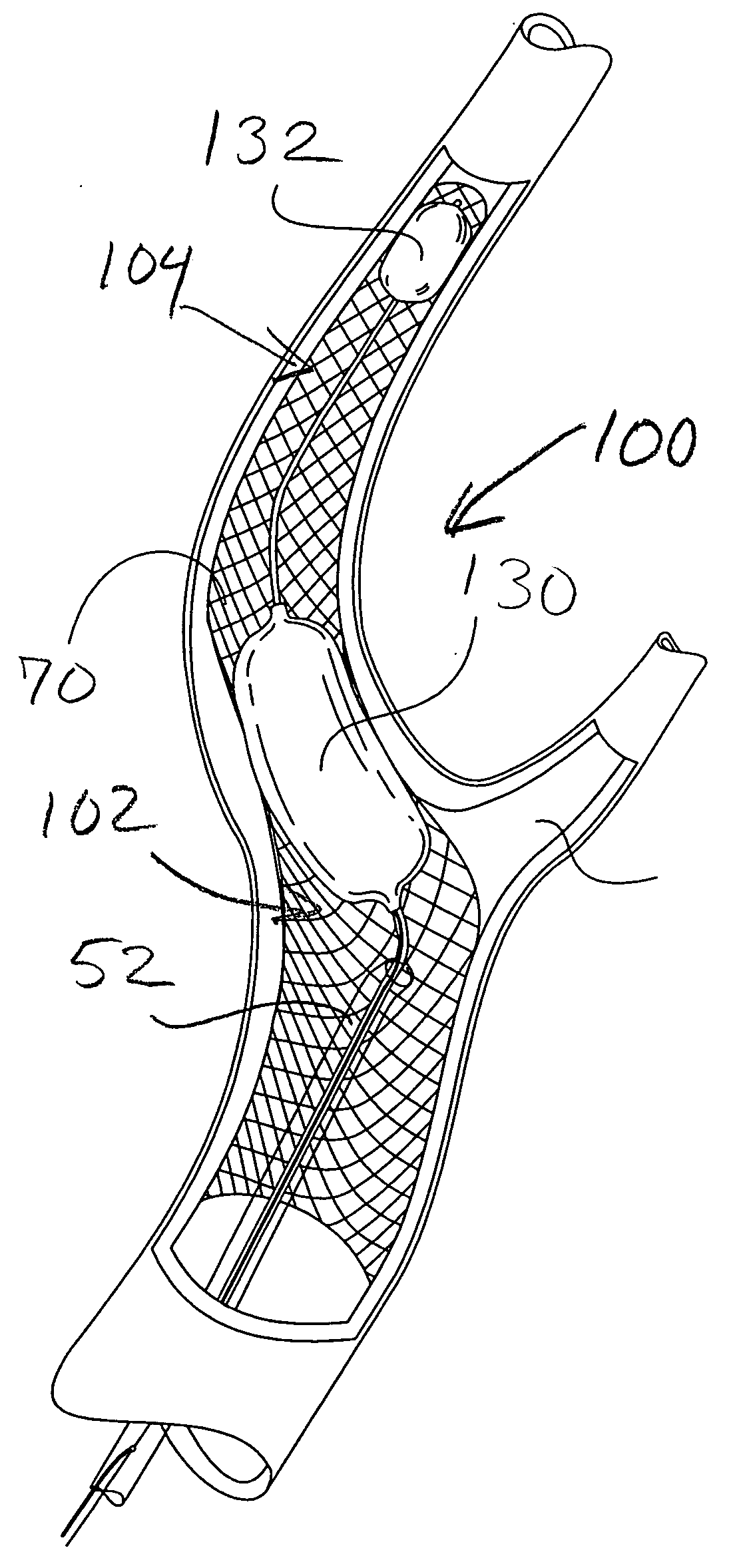 Method of performing protected angioplasty and stenting at a carotid bifurcation