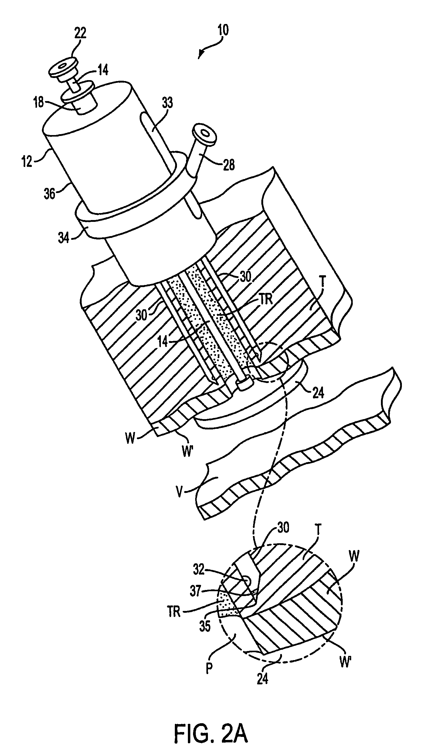 Apparatus for sealing a puncture by causing a reduction in the circumference of the puncture