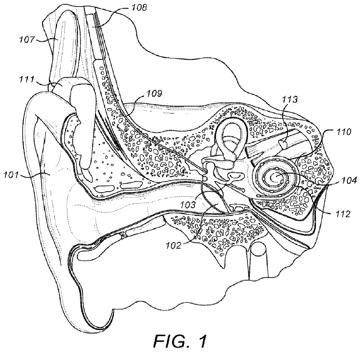 Fast Objective Fitting Measurements for Cochlear Implants