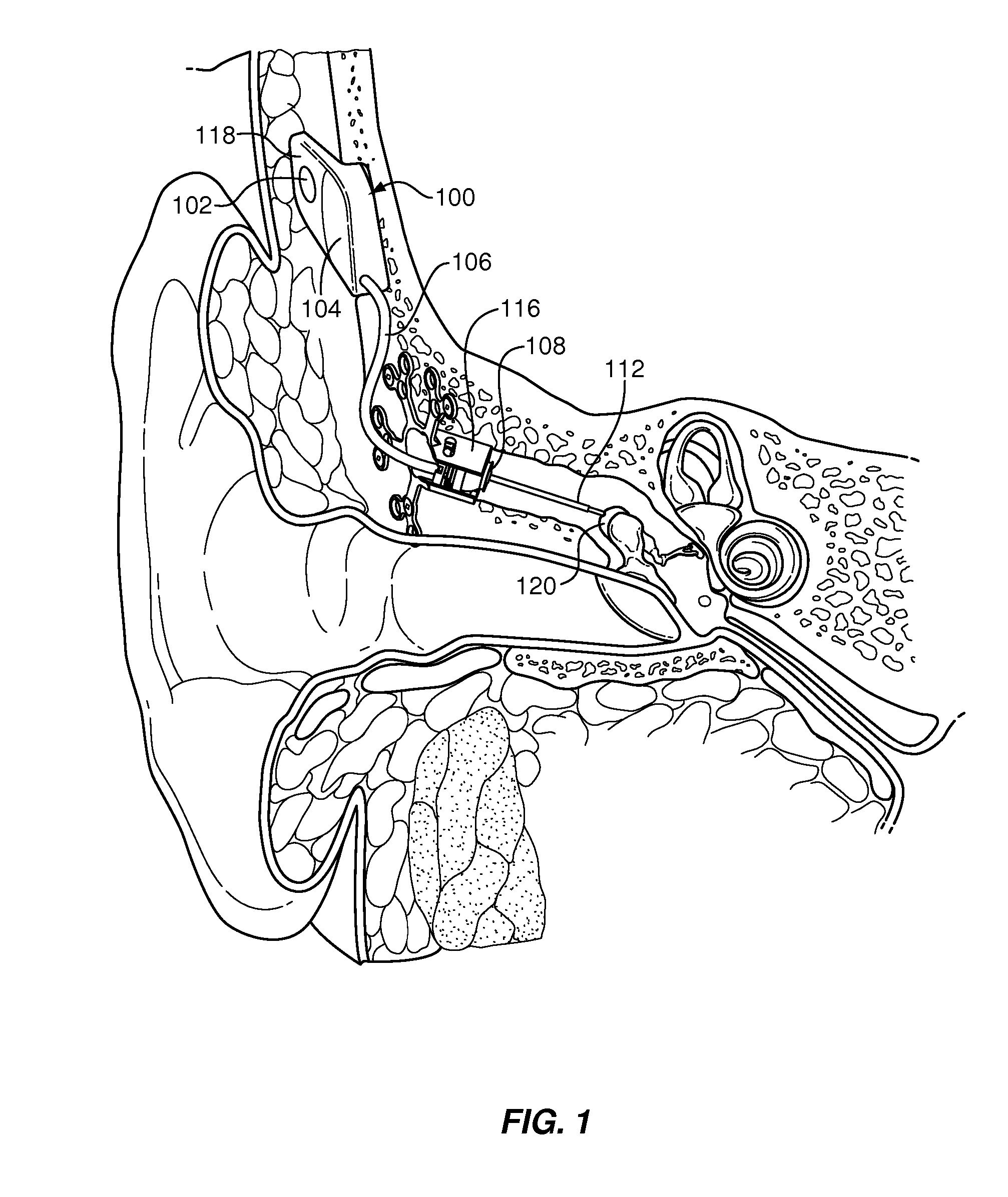 Simplified implantable hearing aid transducer apparatus