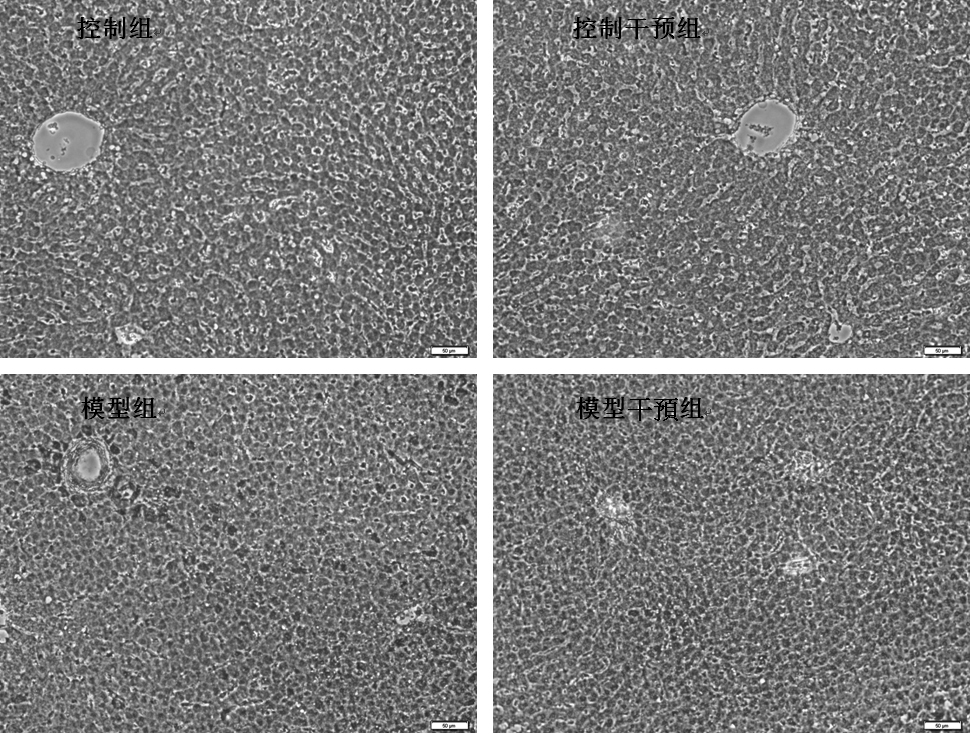 A traditional Chinese medicine composition for treating diabetes complicated with liver fibrosis