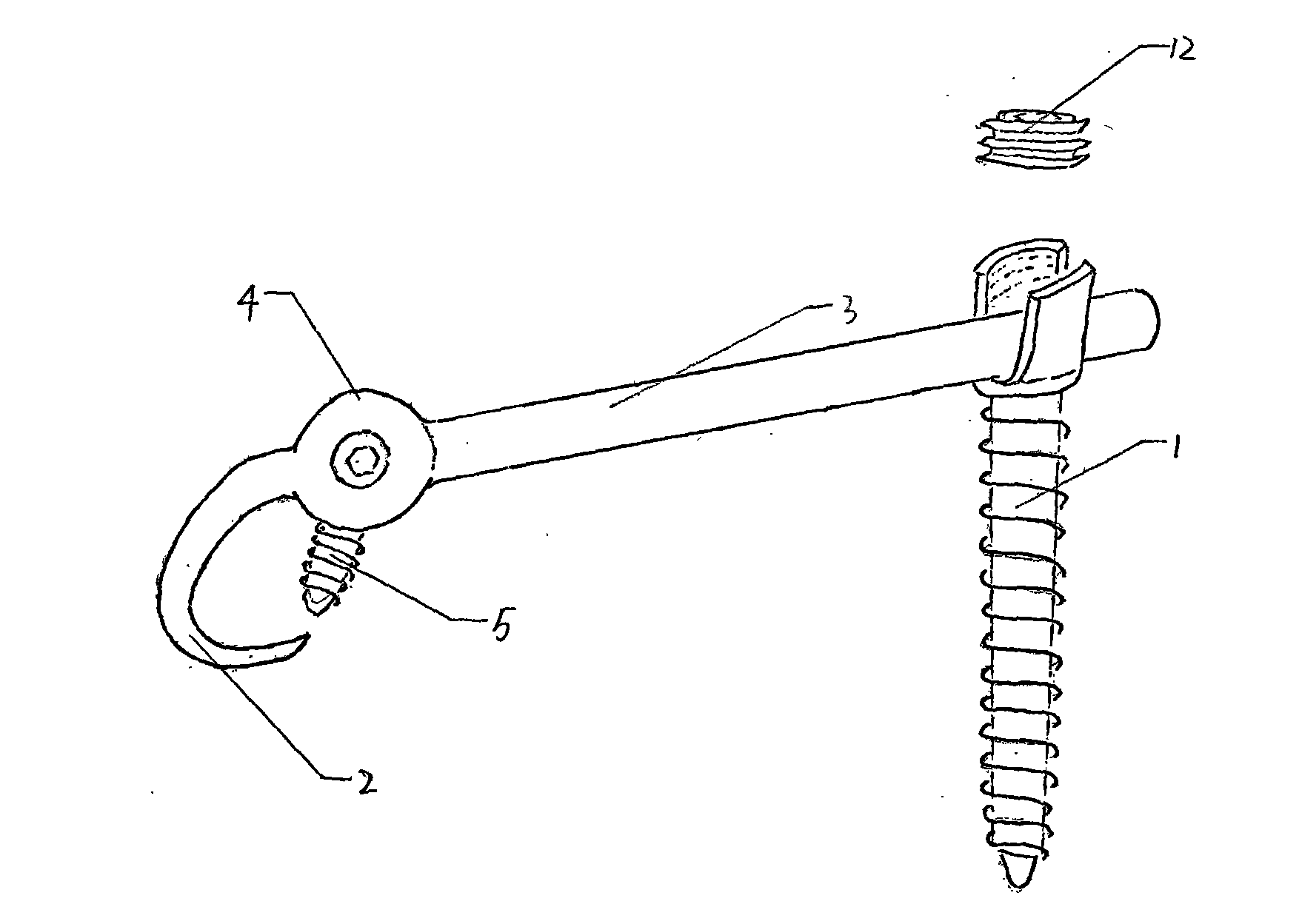 Lumbar spondylolysis restoration internal fixation system