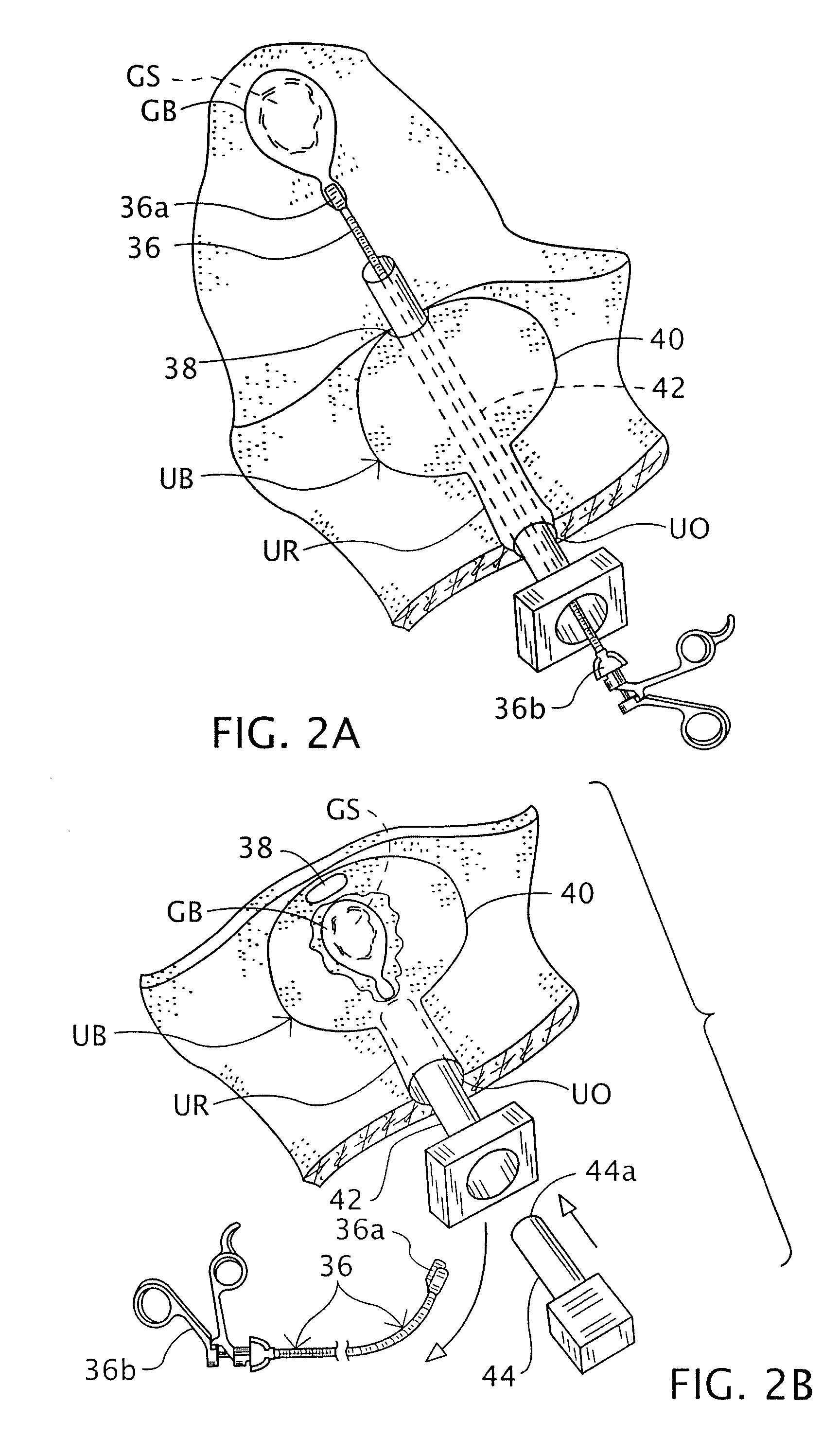 Intra-abdominal medical procedures and device