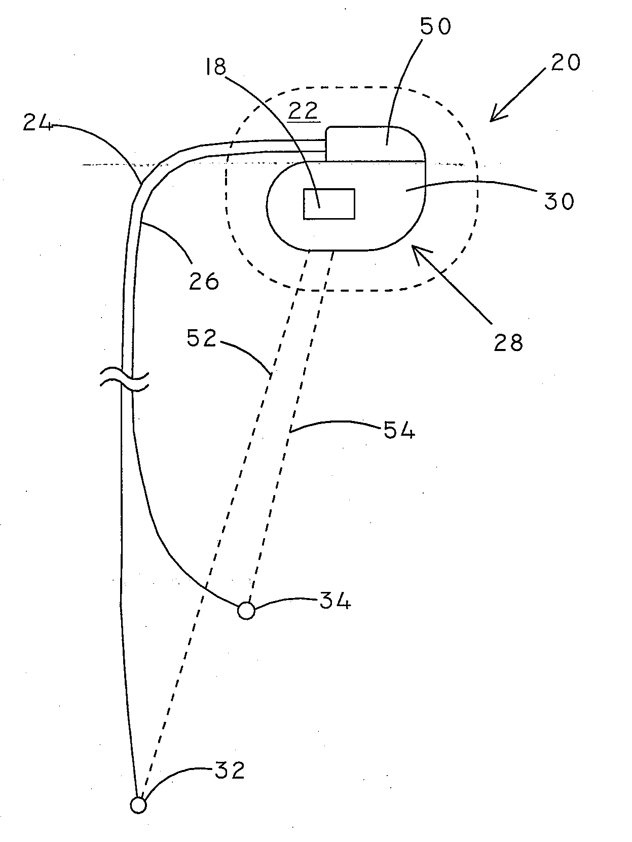 Implantable Medical Device and Methods for Automated Detection of Infection