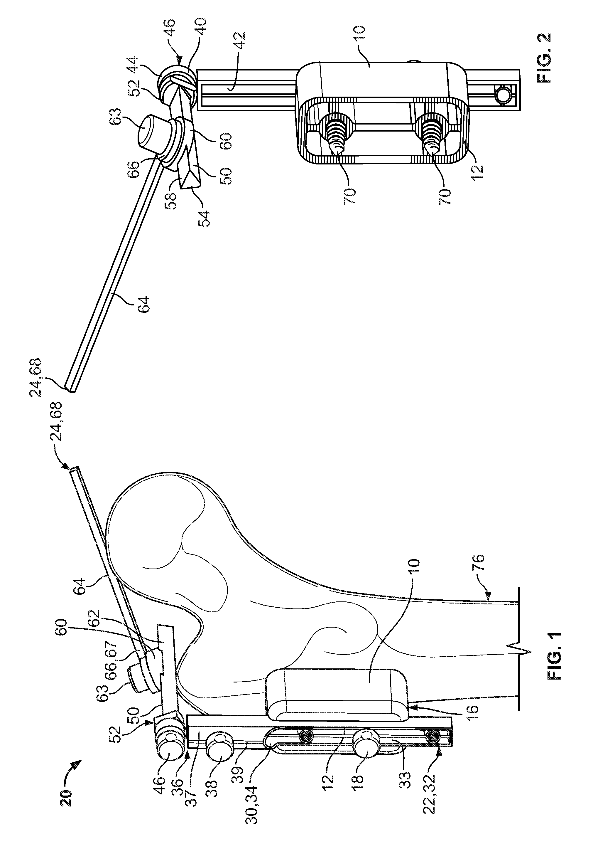 Native version alignment devices and methods