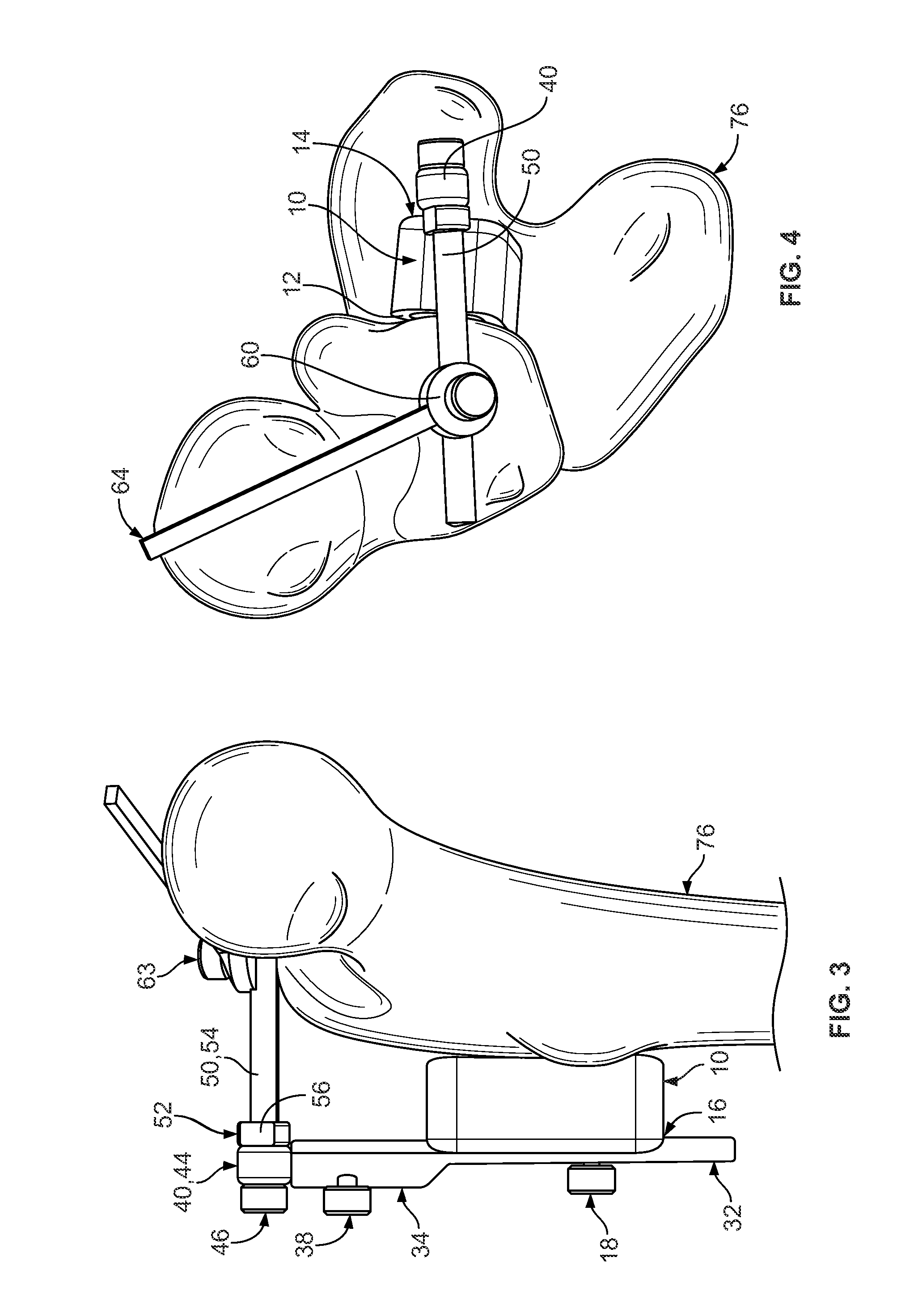 Native version alignment devices and methods