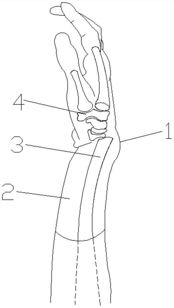 Visual Colles fracture and reduction model device