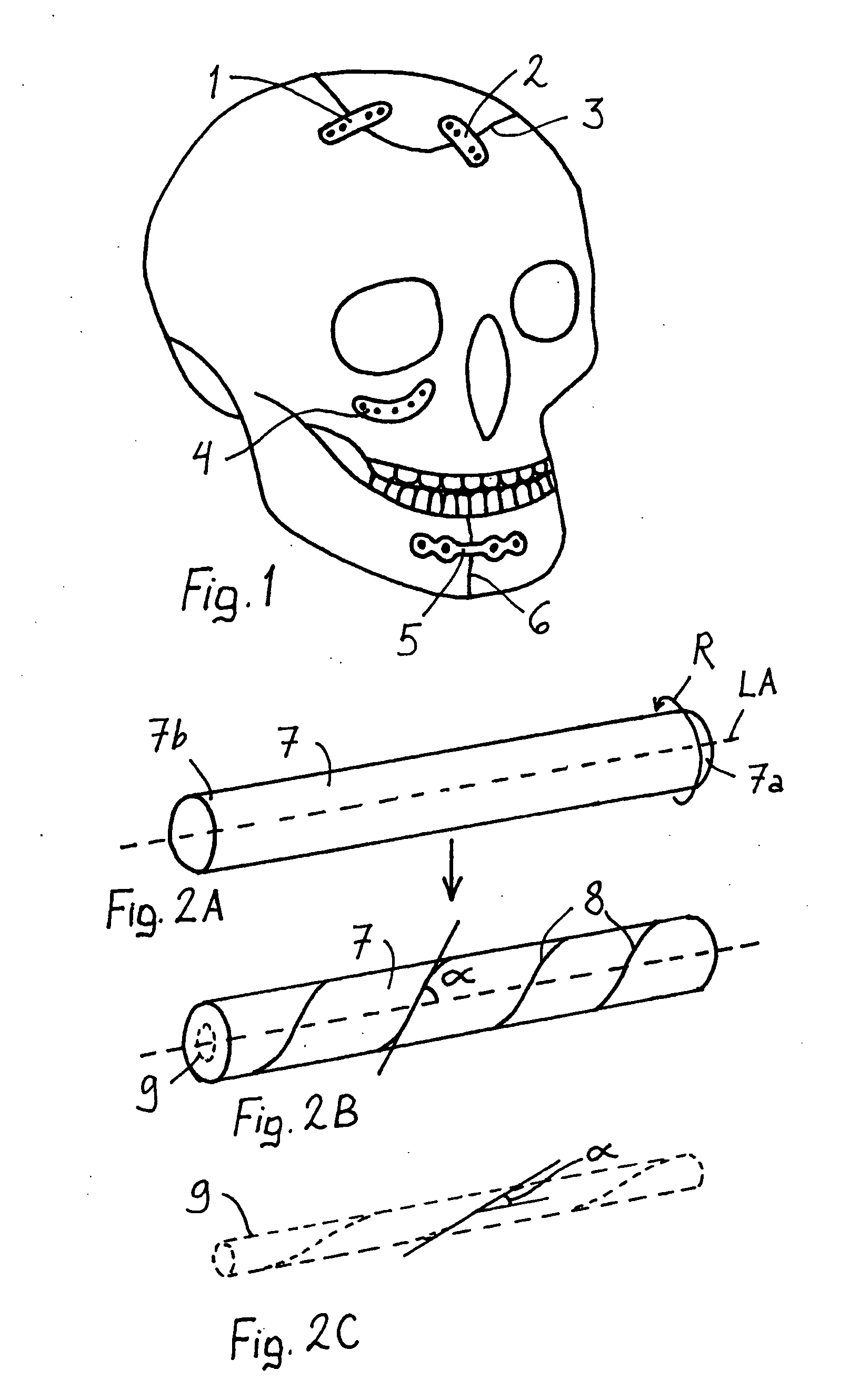 Bioabsorbable, deformable fixation material and implant