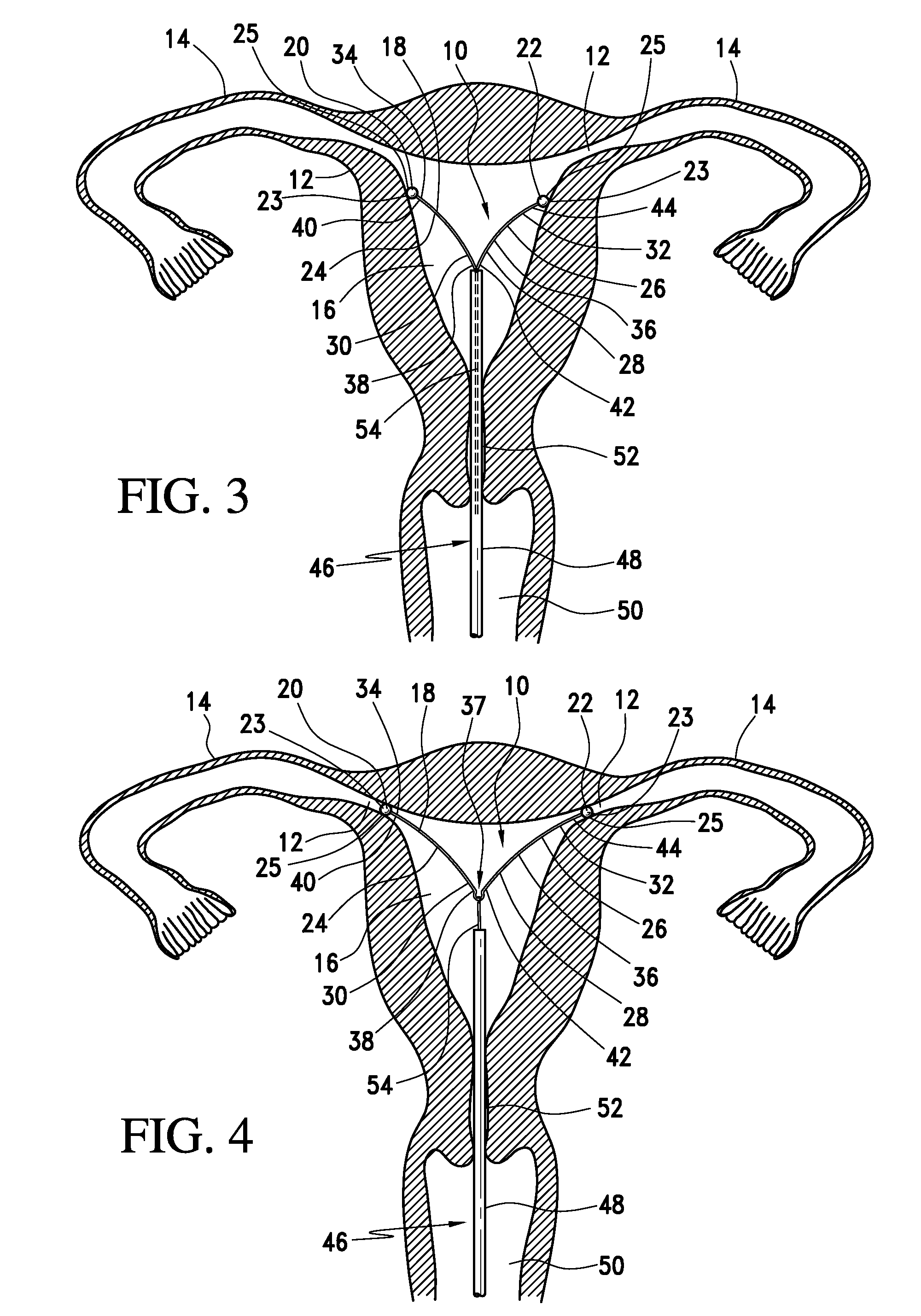 Intrauterine fallopian tube occlusion device