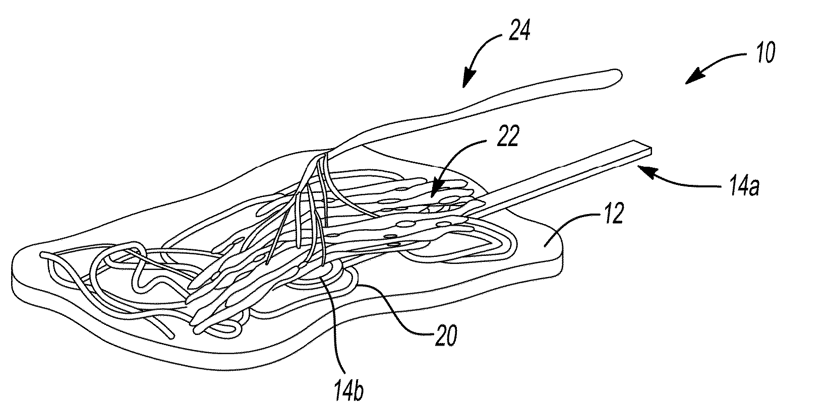 Peripheral nerve interface devices for treatment and prevention of neuromas