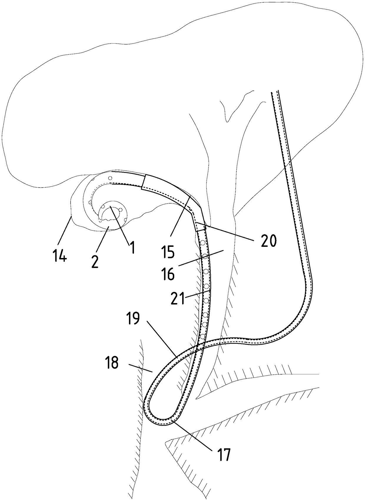 Nasal gallbladder bile drainage catheter with expansile saccule