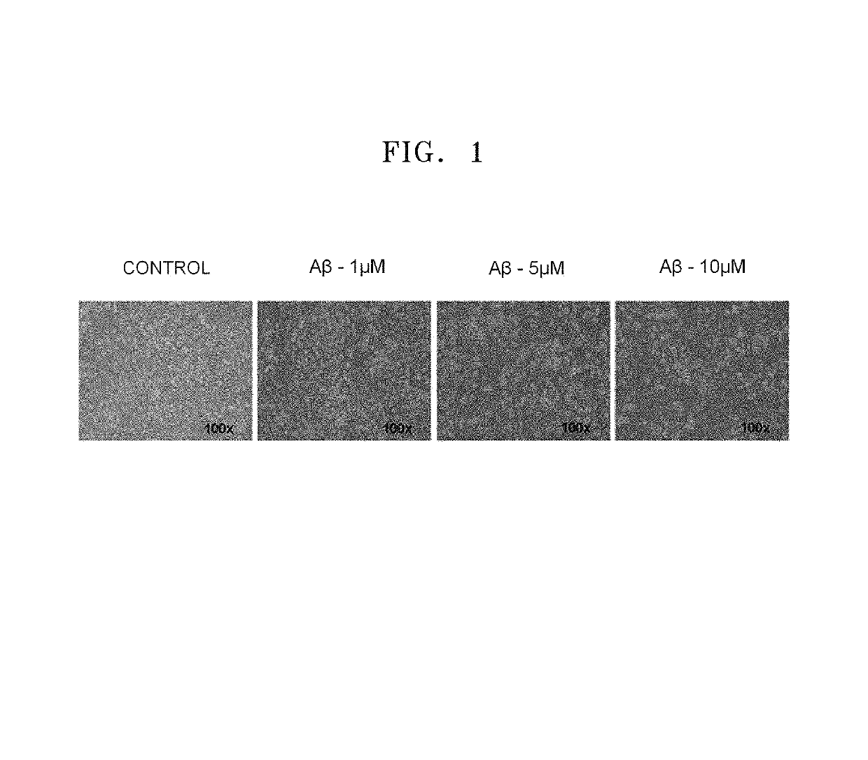 Composition comprising a culture solution of mesenchymal stem cells for the treatment of neural diseases