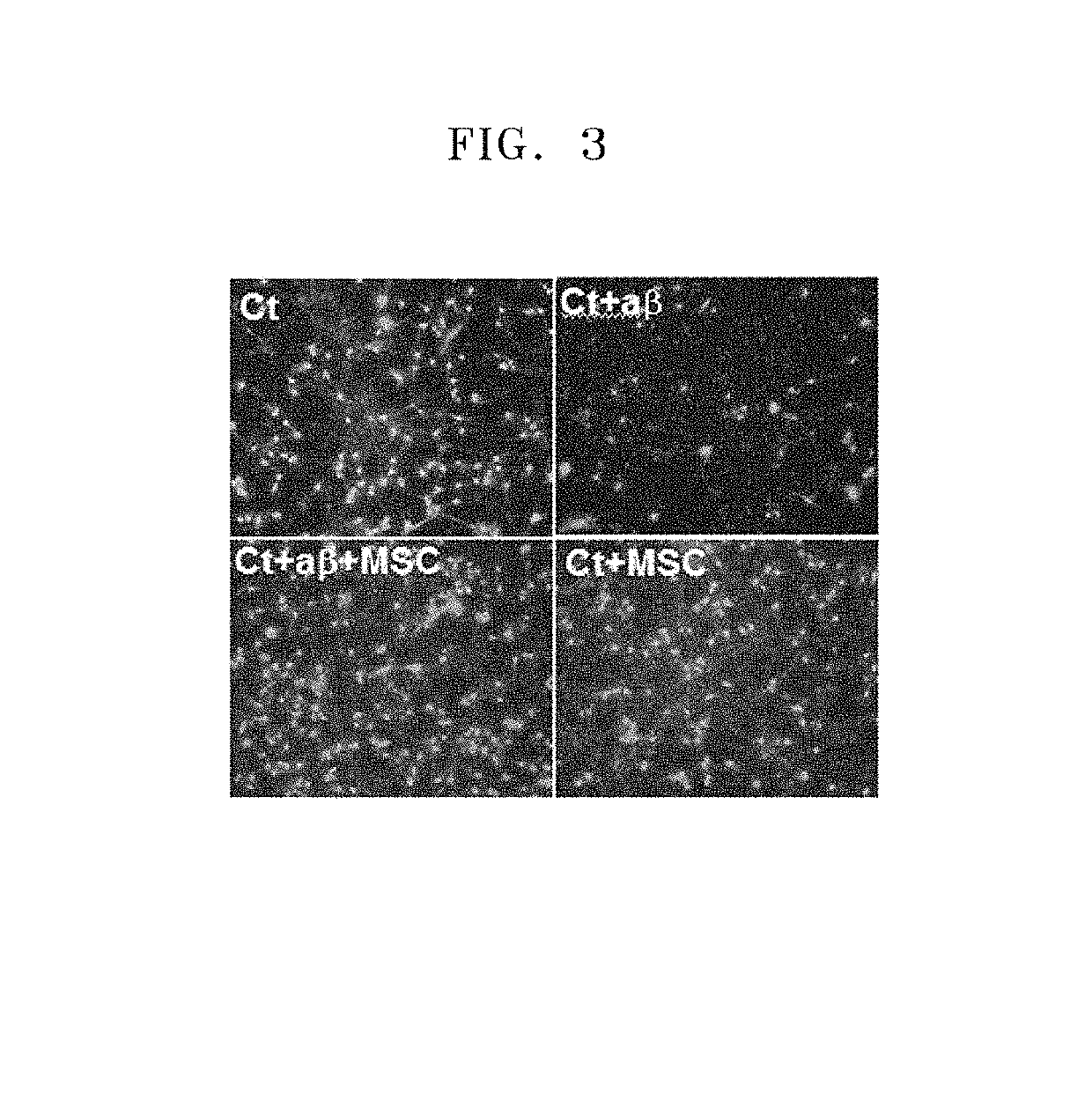 Composition comprising a culture solution of mesenchymal stem cells for the treatment of neural diseases