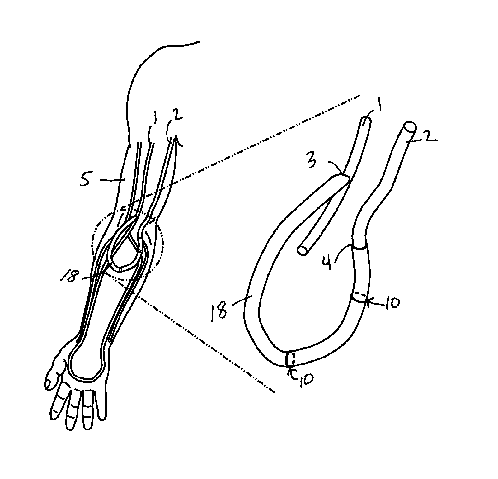 Hemodialysis arterio-venous graft with a ring-like diameter-adjustable device