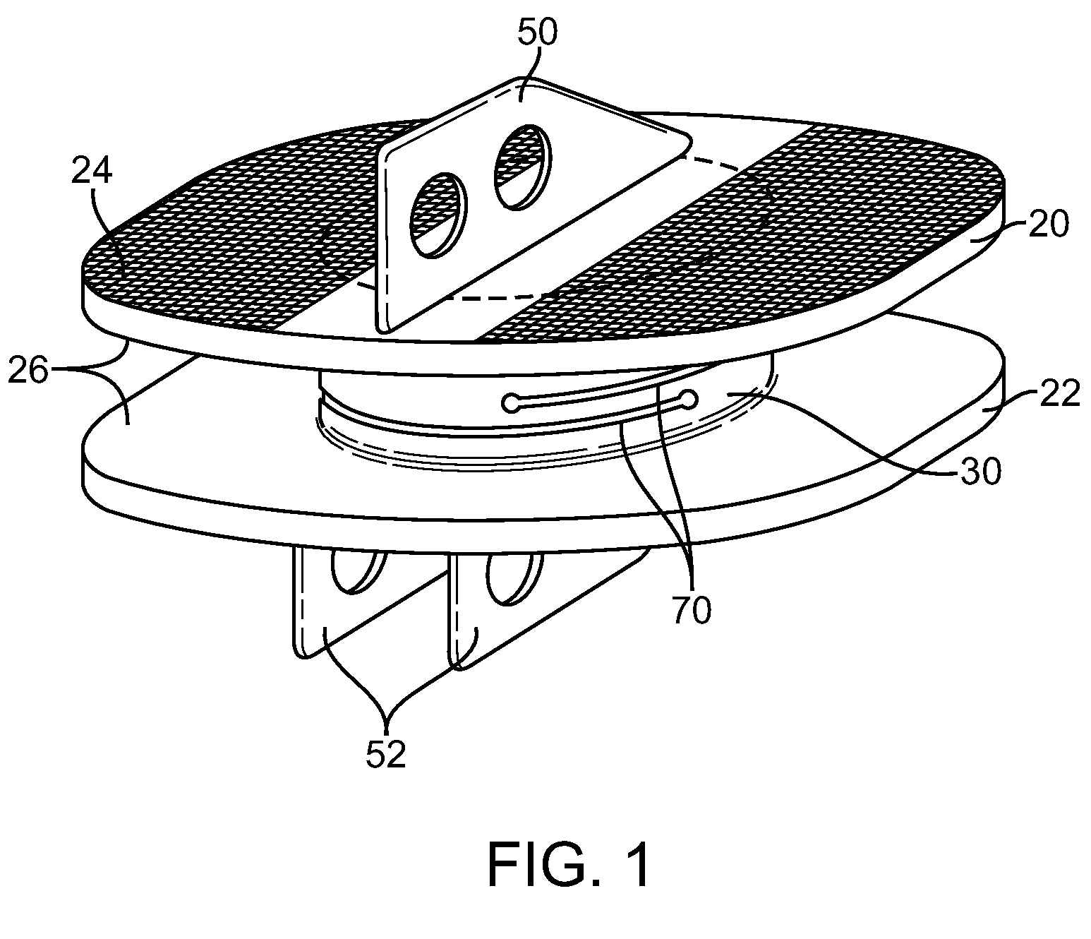 Dynamic Spacer Device and Method for Spanning a Space Formed upon Removal of an Intervertebral Disc