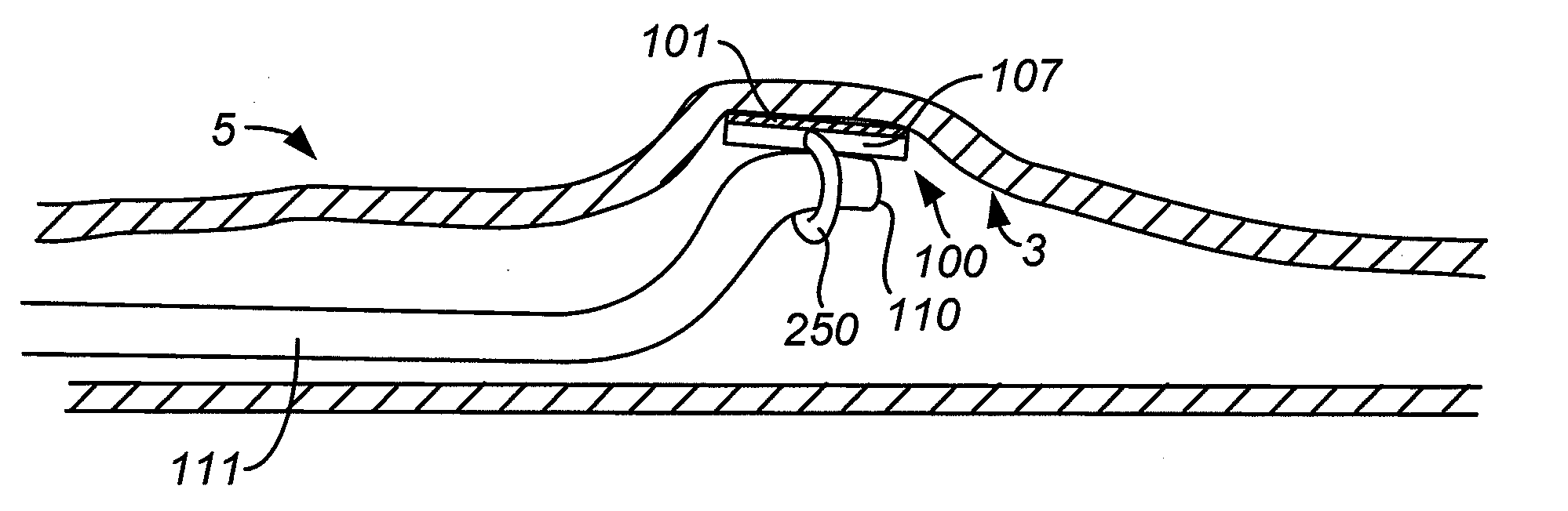 Method and Apparatus for Gastrointestinal Tract Ablation to Achieve Loss of Persistent and/or Recurrent Excess Body Weight Following a Weight-Loss Operation