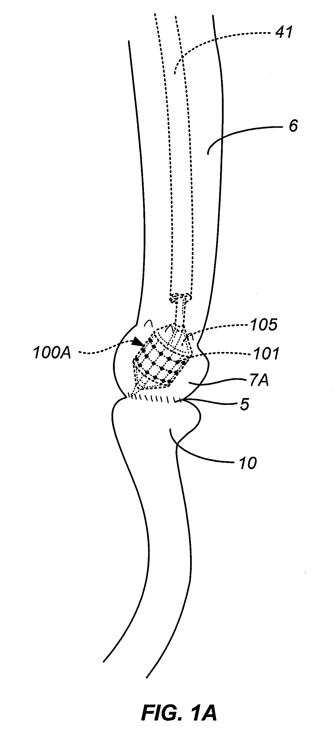 Method and Apparatus for Gastrointestinal Tract Ablation to Achieve Loss of Persistent and/or Recurrent Excess Body Weight Following a Weight-Loss Operation