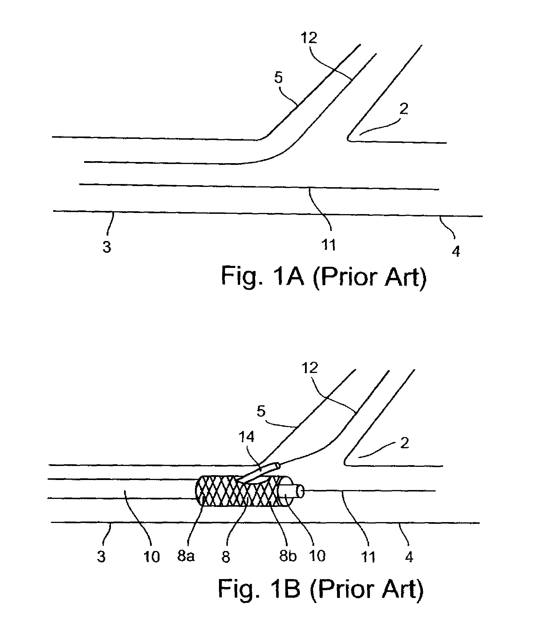 Methods for deploying stents in bifurcations
