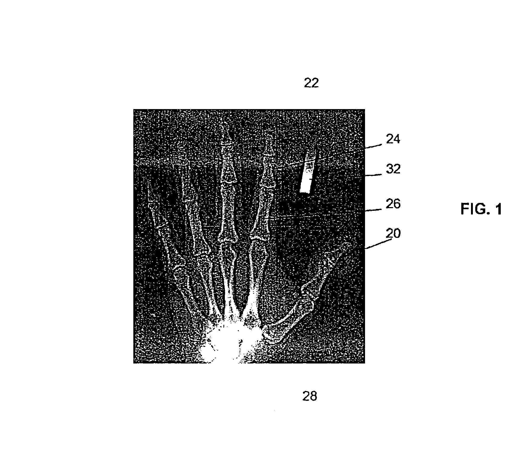 Method, code, and system for assaying joint deformity