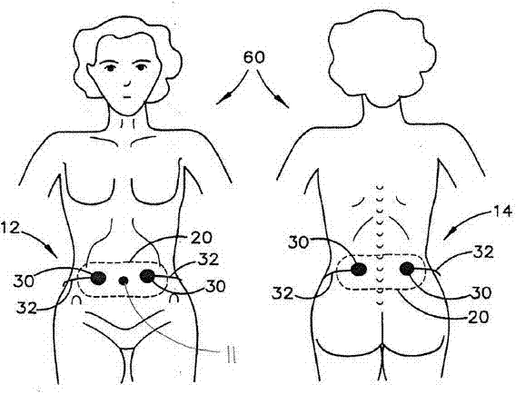 Transcutaneous stimulation method and system