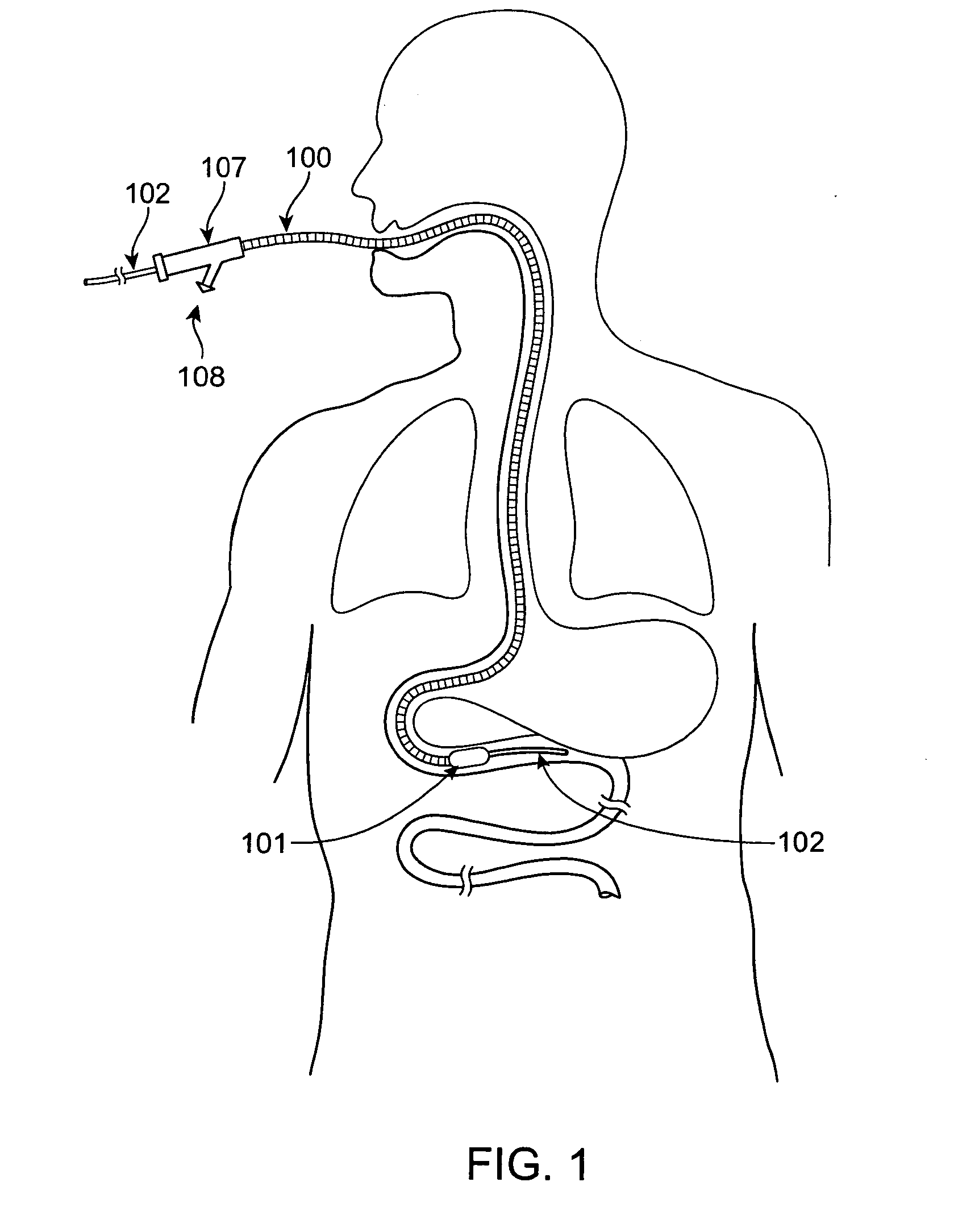 Methods and devices for obesity treatment