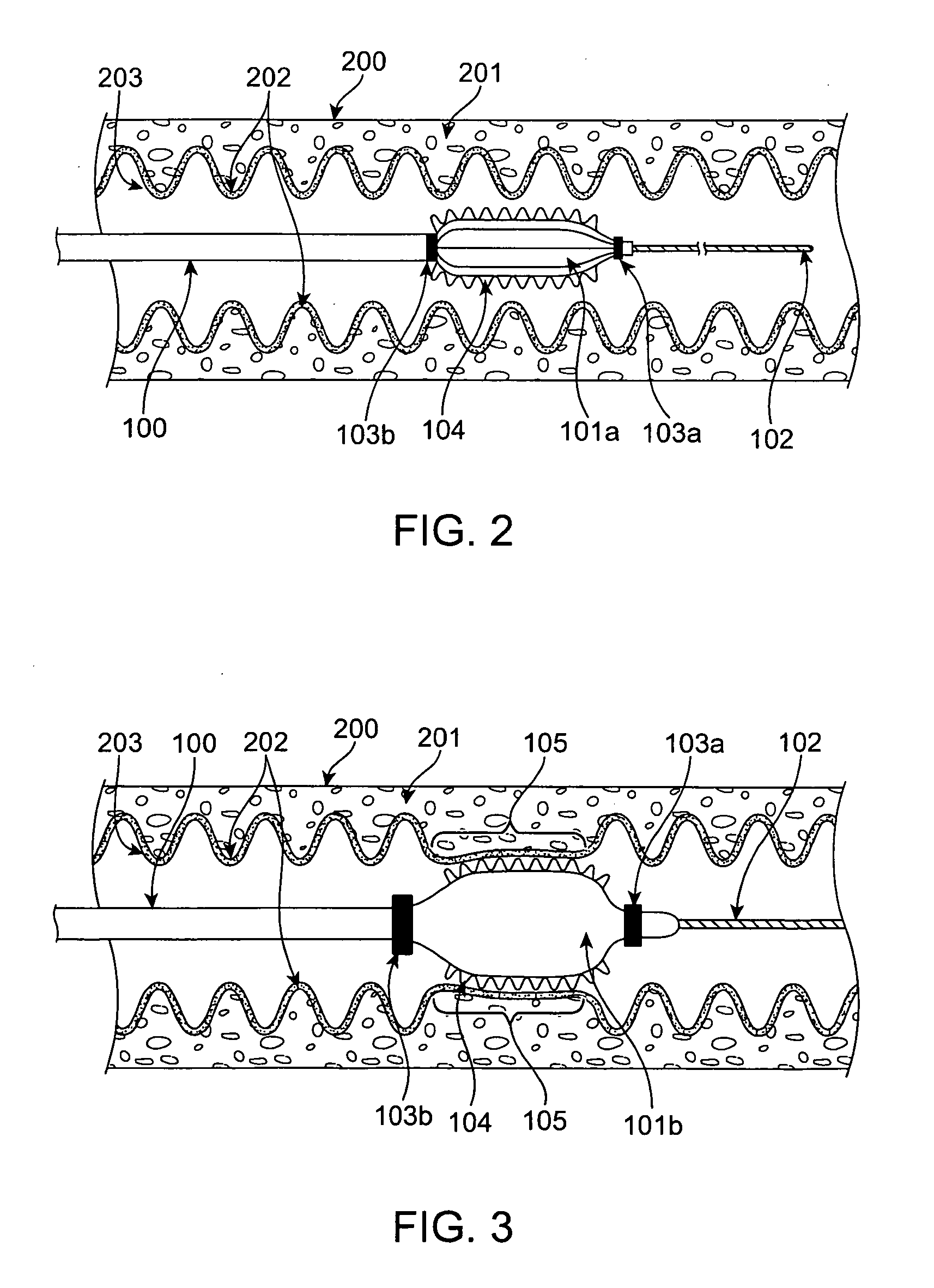 Methods and devices for obesity treatment