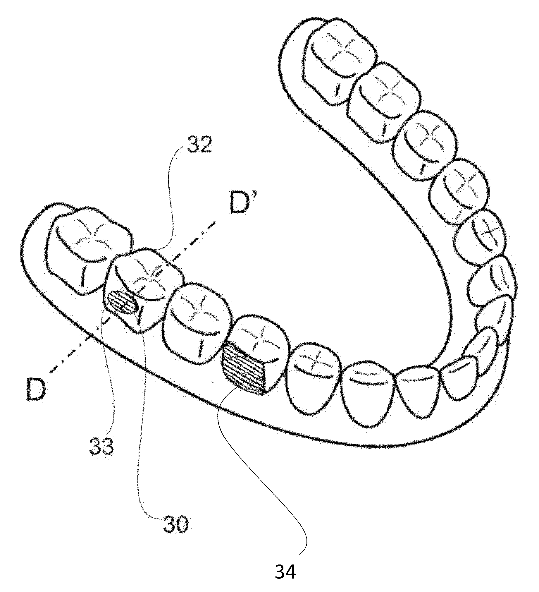 Adhesion pads for fastening an orthodontic aligner