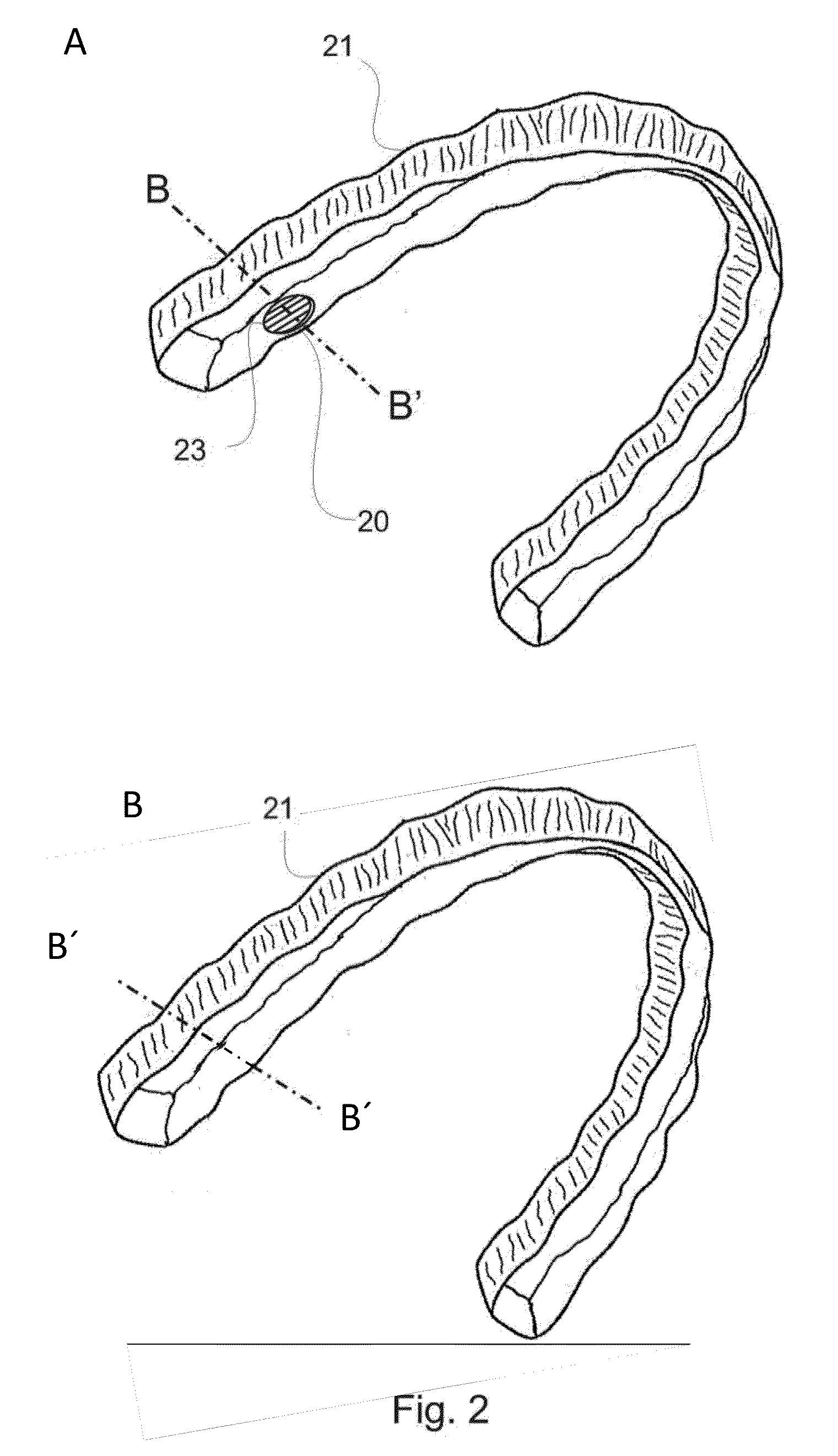 Adhesion pads for fastening an orthodontic aligner