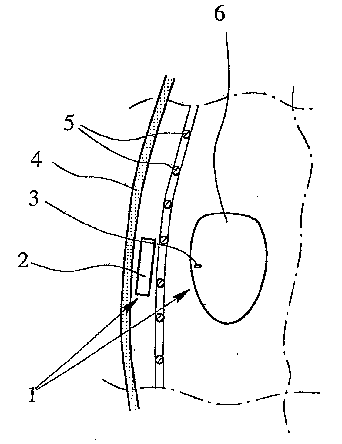 Stimulation system, in particular a cardiac pacemaker