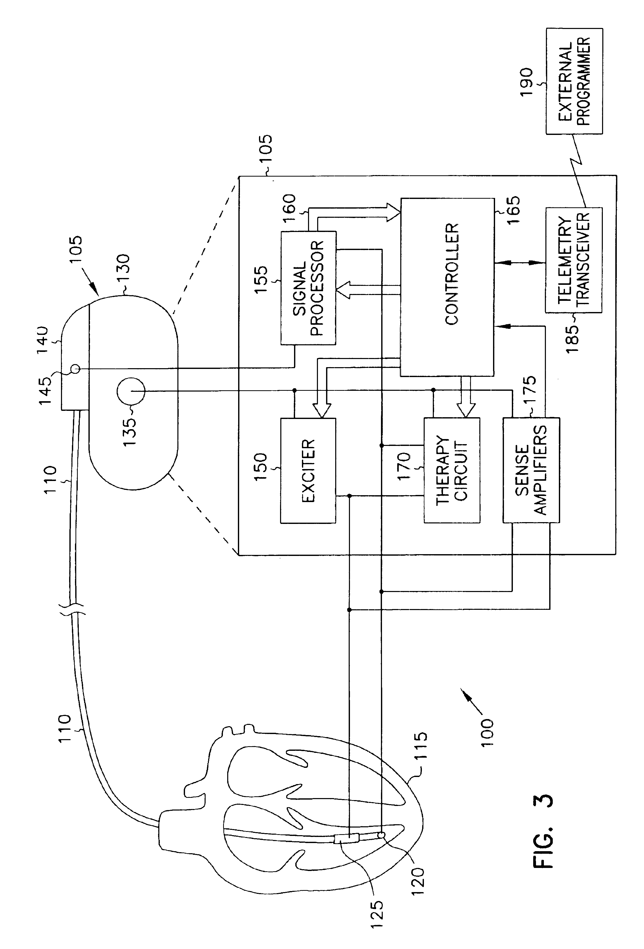 Minute ventilation sensor with automatic high pass filter adjustment