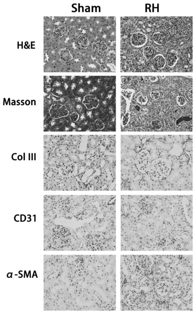 Application of miR-122-5p as renal fibrosis non-invasive diagnostic marker and detection kit