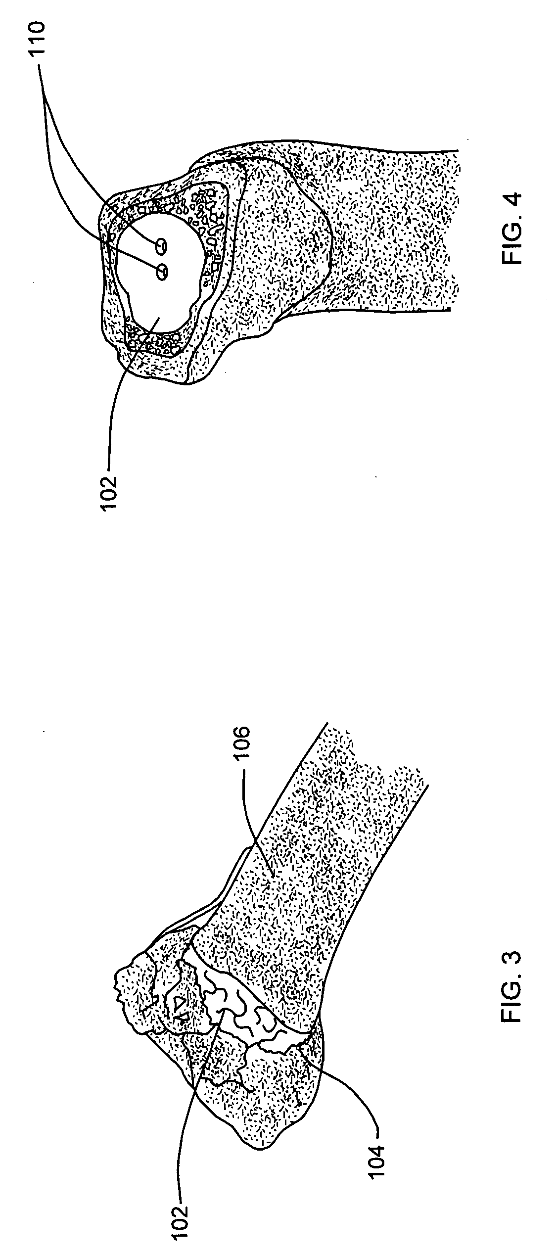 Method for augmenting, reducing, and repairing bone with thermoplastic materials
