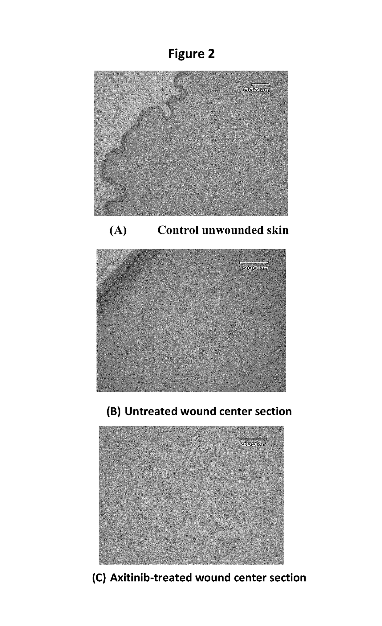 Compositions and methods of treating dermal fibrotic disorders