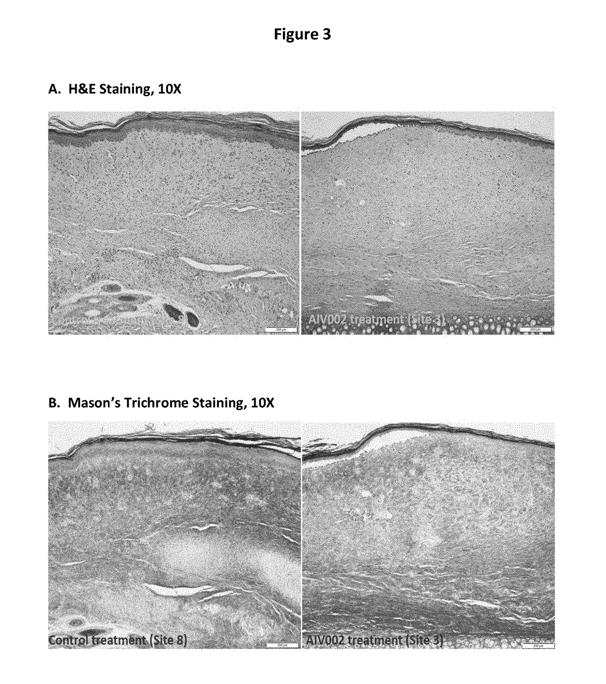 Compositions and methods of treating dermal fibrotic disorders